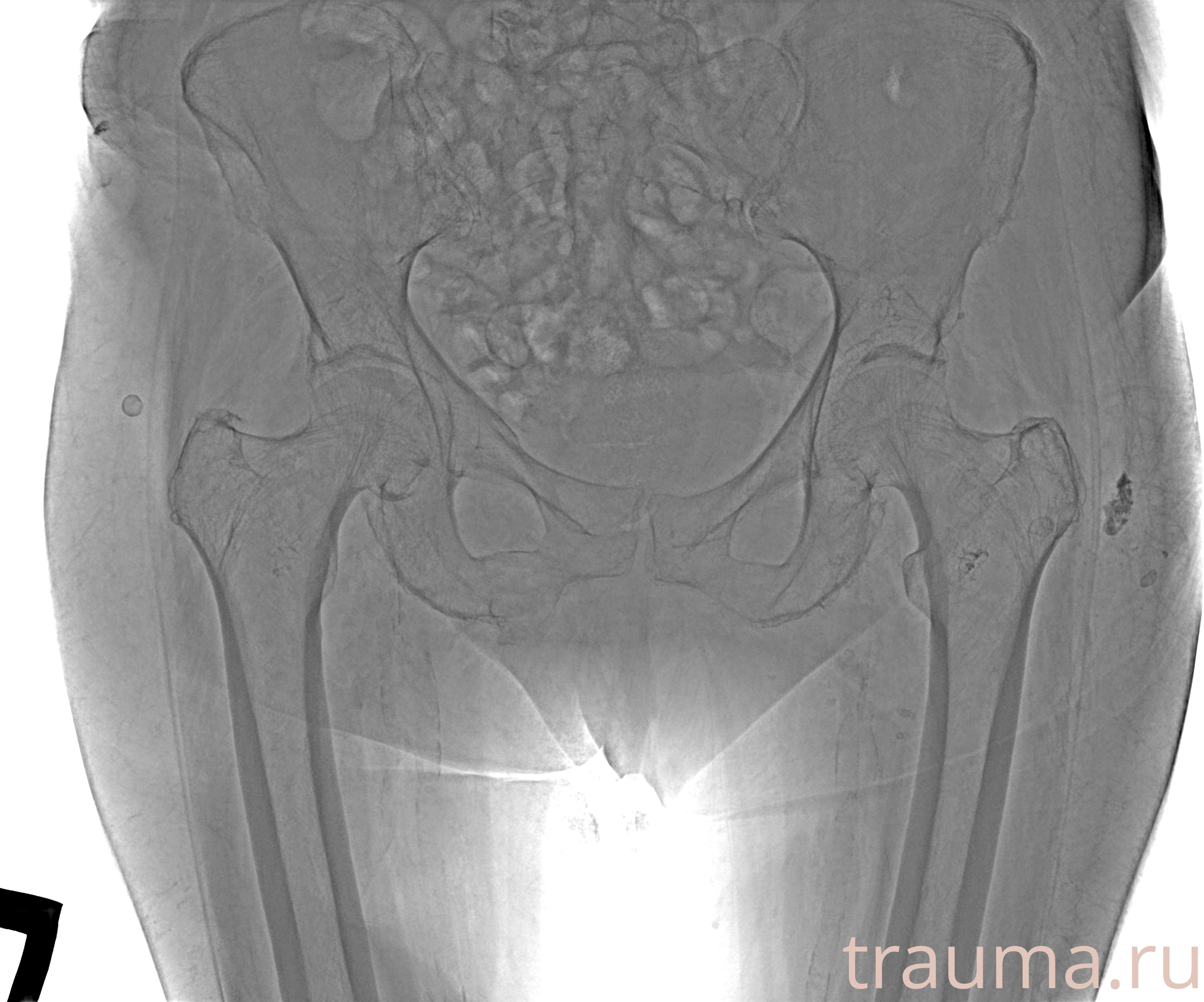 Рентген на дому: по вашему адресу приезжает врач-рентгенолог, травматолог-ортопед с мобильным рентгеновским аппаратом, проводит диагностику травмы или заболевания, делает необходимые рентгенограммы, дает рекомендации по дальнейшему лечению. Получить качественные снимки в домашних условиях возможно благодаря уникальной методике, разработанной МосРентген Центром для института  Склифосовского