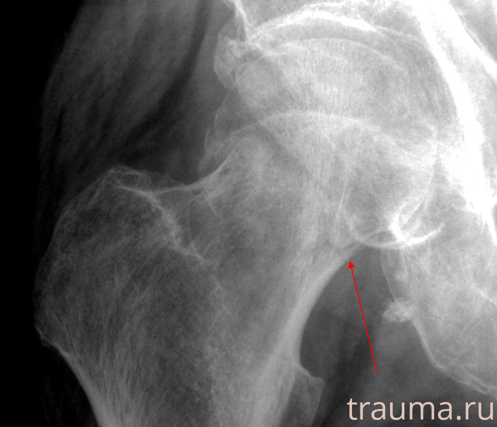 Рентген на дому: по вашему адресу приезжает врач-рентгенолог, травматолог-ортопед с мобильным рентгеновским аппаратом, проводит диагностику травмы или заболевания, делает необходимые рентгенограммы, дает рекомендации по дальнейшему лечению. Получить качественные снимки в домашних условиях возможно благодаря уникальной методике, разработанной МосРентген Центром для института  Склифосовского