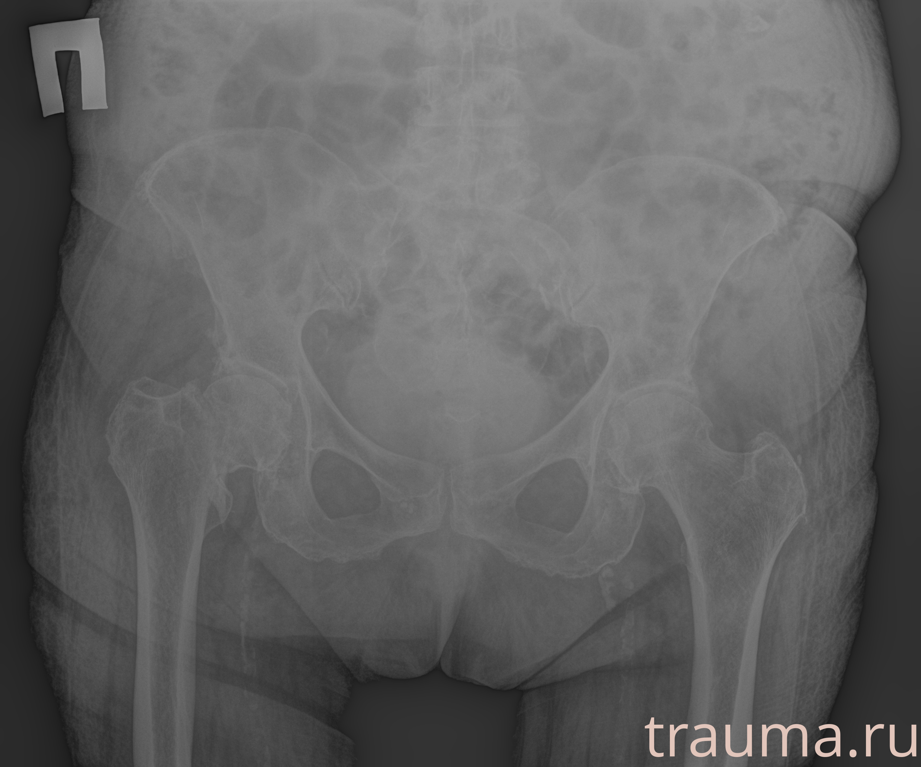 Рентген на дому: по вашему адресу приезжает врач-рентгенолог, травматолог-ортопед с мобильным рентгеновским аппаратом, проводит диагностику травмы или заболевания, делает необходимые рентгенограммы, дает рекомендации по дальнейшему лечению. Получить качественные снимки в домашних условиях возможно благодаря уникальной методике, разработанной МосРентген Центром для института  Склифосовского