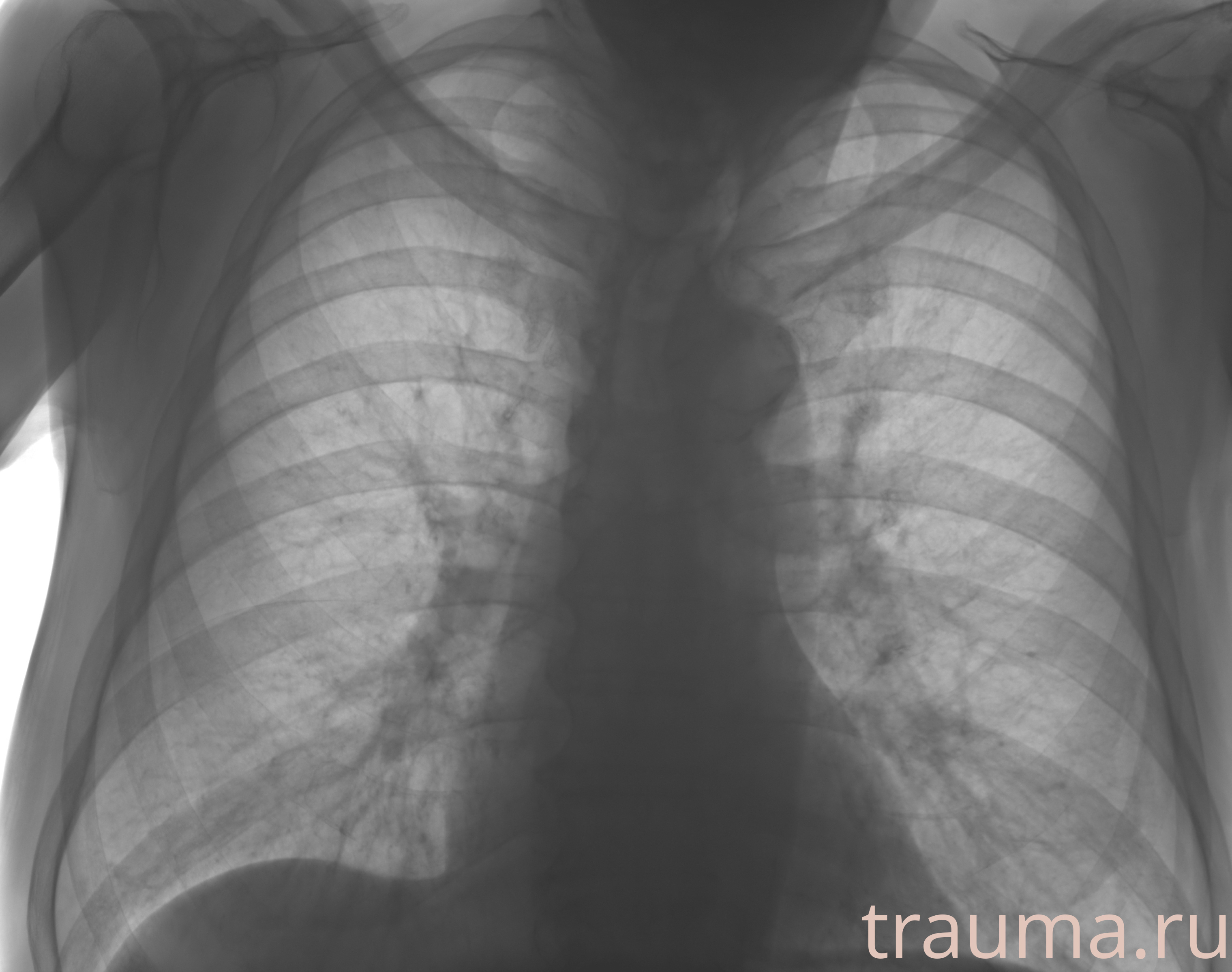 Рентген на дому: по вашему адресу приезжает врач-рентгенолог, травматолог-ортопед с мобильным рентгеновским аппаратом, проводит диагностику травмы или заболевания, делает необходимые рентгенограммы, дает рекомендации по дальнейшему лечению. Получить качественные снимки в домашних условиях возможно благодаря уникальной методике, разработанной МосРентген Центром для института  Склифосовского