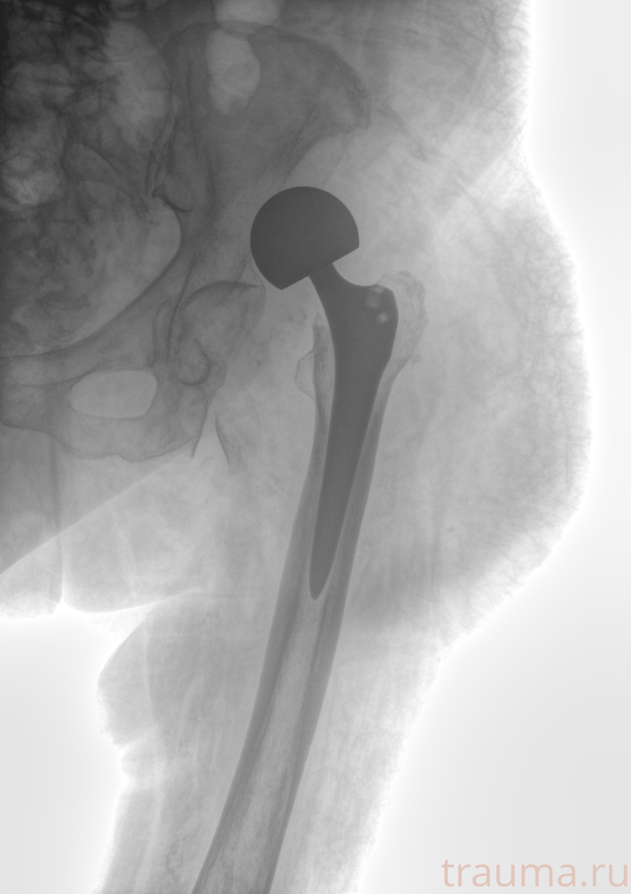 Рентген на дому: по вашему адресу приезжает врач-рентгенолог, травматолог-ортопед с мобильным рентгеновским аппаратом, проводит диагностику травмы или заболевания, делает необходимые рентгенограммы, дает рекомендации по дальнейшему лечению. Получить качественные снимки в домашних условиях возможно благодаря уникальной методике, разработанной МосРентген Центром для института  Склифосовского