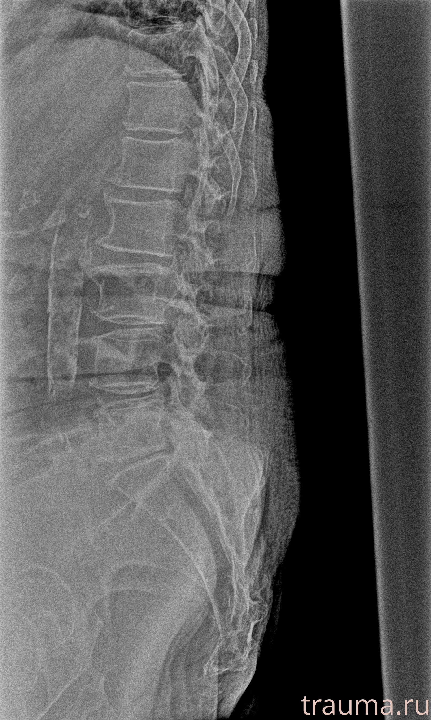 Рентген на дому: по вашему адресу приезжает врач-рентгенолог, травматолог-ортопед с мобильным рентгеновским аппаратом, проводит диагностику травмы или заболевания, делает необходимые рентгенограммы, дает рекомендации по дальнейшему лечению. Получить качественные снимки в домашних условиях возможно благодаря уникальной методике, разработанной МосРентген Центром для института  Склифосовского