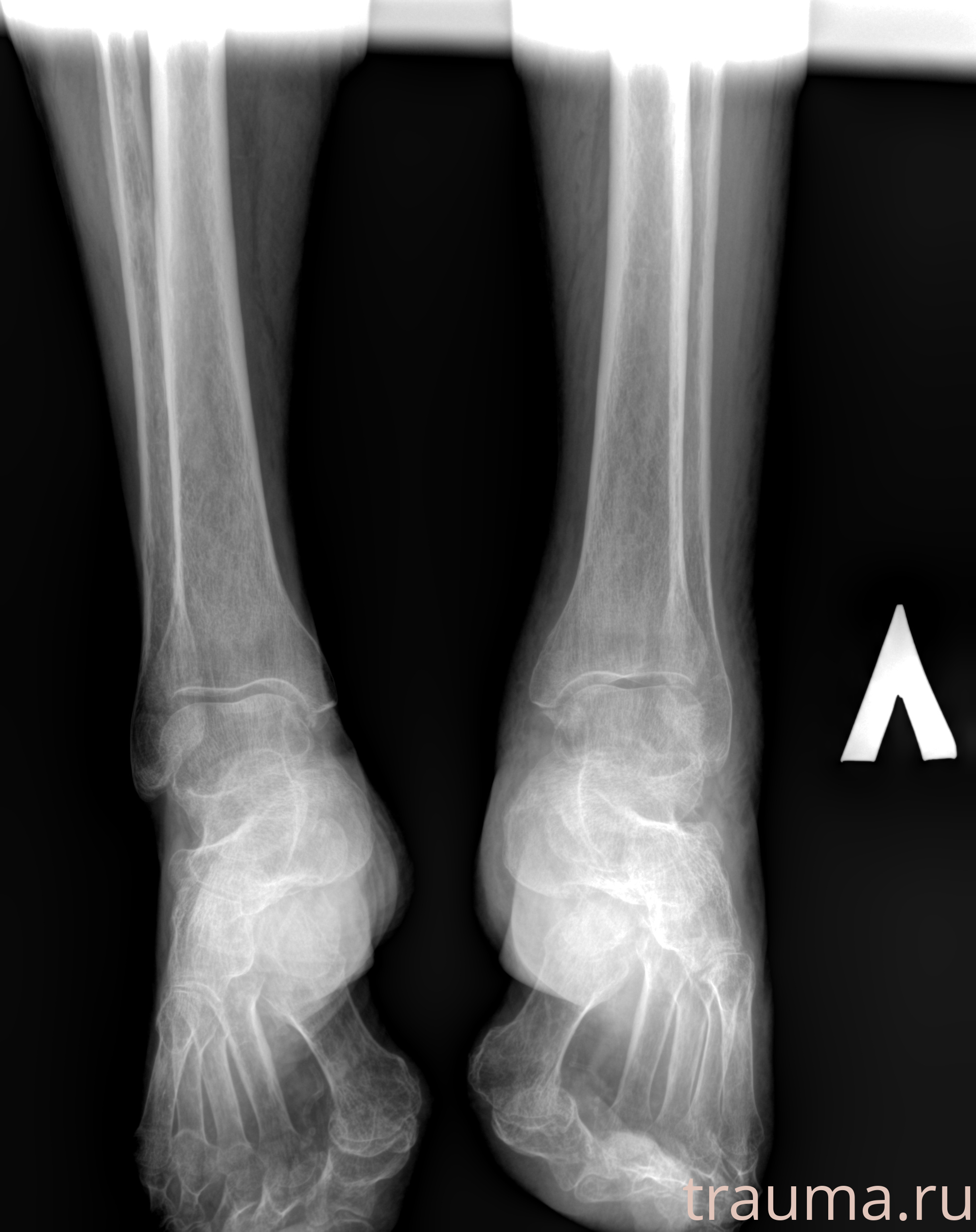 Рентген на дому: по вашему адресу приезжает врач-рентгенолог, травматолог-ортопед с мобильным рентгеновским аппаратом, проводит диагностику травмы или заболевания, делает необходимые рентгенограммы, дает рекомендации по дальнейшему лечению. Получить качественные снимки в домашних условиях возможно благодаря уникальной методике, разработанной МосРентген Центром для института  Склифосовского