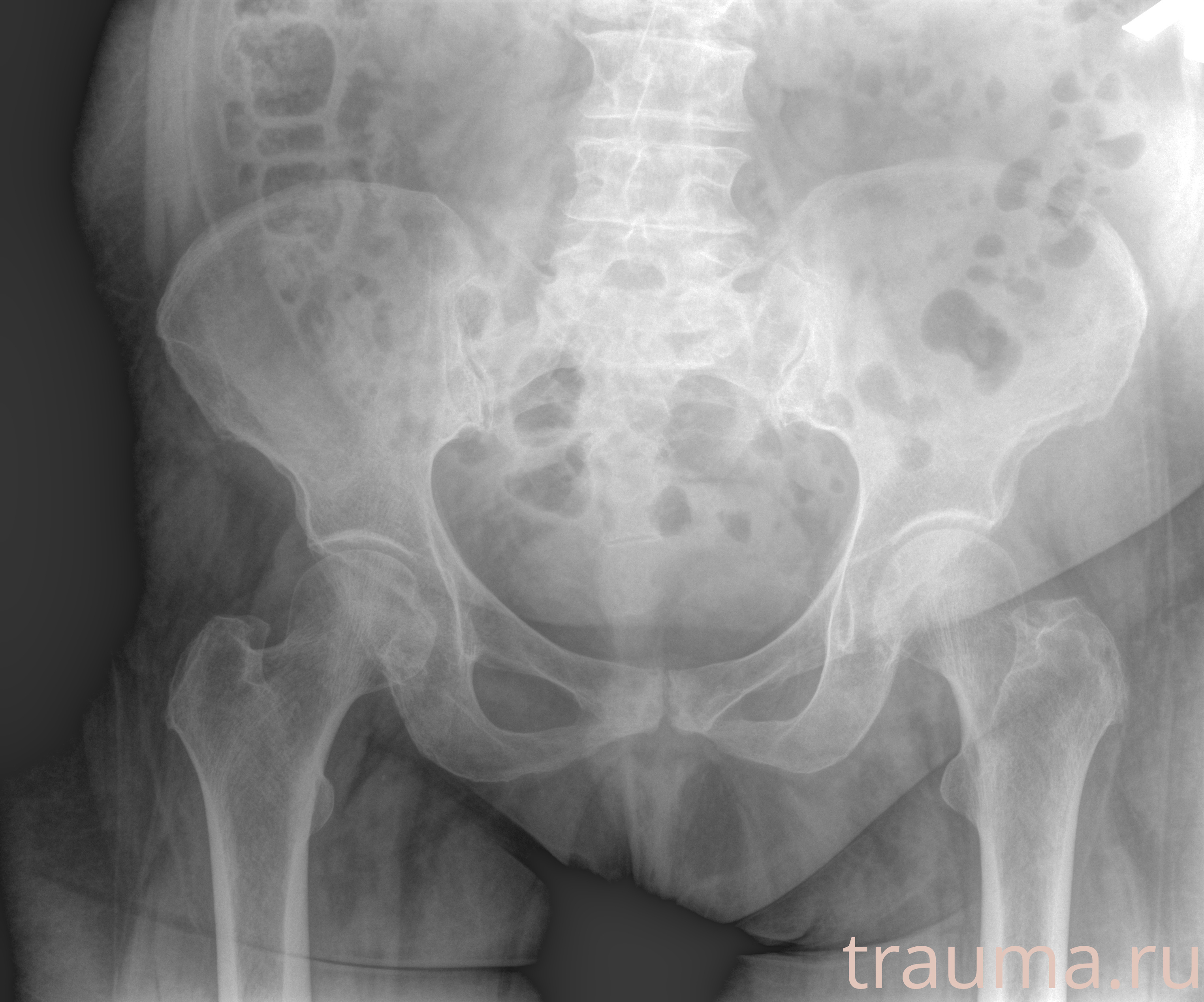 Рентген на дому: по вашему адресу приезжает врач-рентгенолог, травматолог-ортопед с мобильным рентгеновским аппаратом, проводит диагностику травмы или заболевания, делает необходимые рентгенограммы, дает рекомендации по дальнейшему лечению. Получить качественные снимки в домашних условиях возможно благодаря уникальной методике, разработанной МосРентген Центром для института  Склифосовского