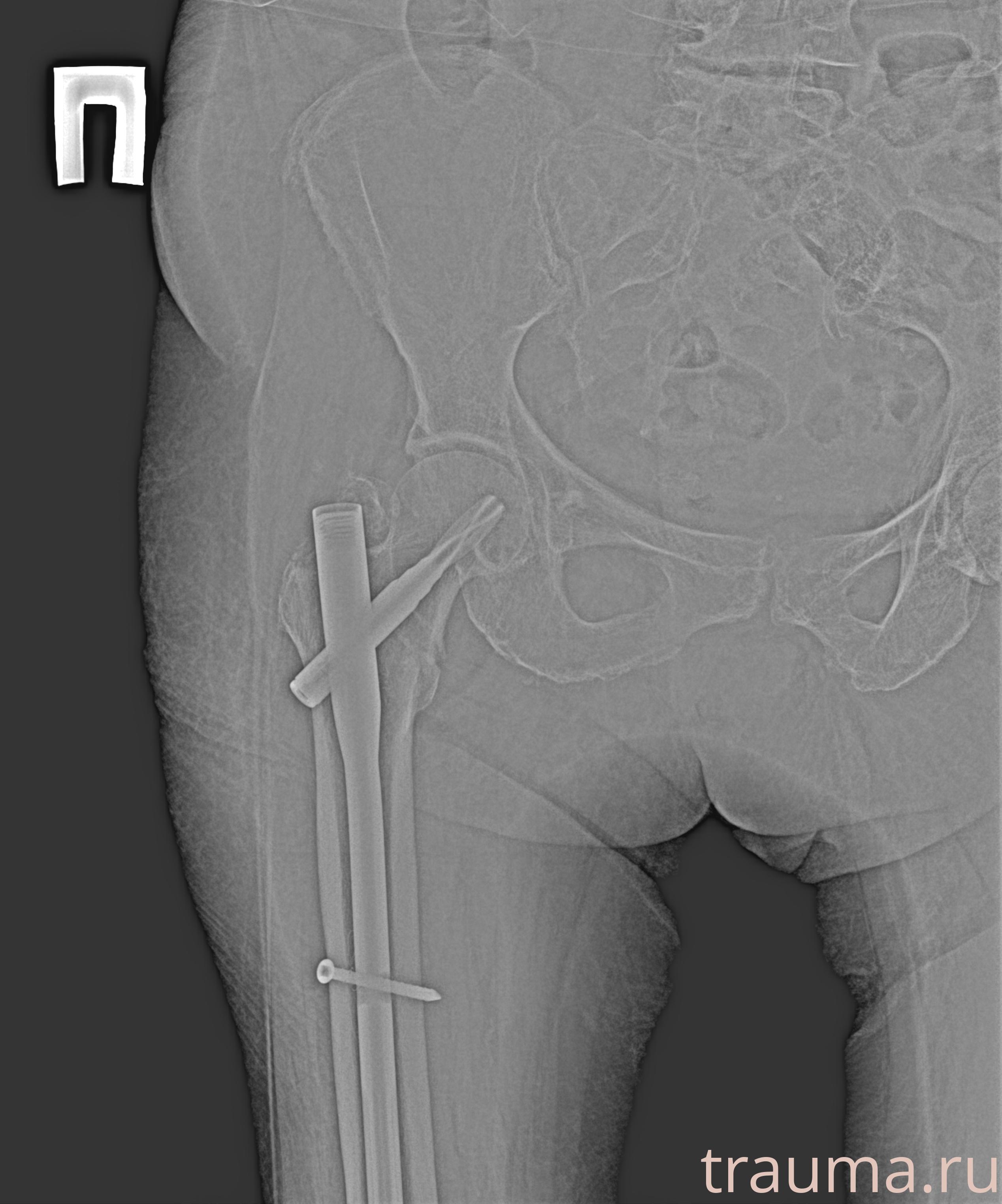 Рентген на дому: по вашему адресу приезжает врач-рентгенолог, травматолог-ортопед с мобильным рентгеновским аппаратом, проводит диагностику травмы или заболевания, делает необходимые рентгенограммы, дает рекомендации по дальнейшему лечению. Получить качественные снимки в домашних условиях возможно благодаря уникальной методике, разработанной МосРентген Центром для института  Склифосовского