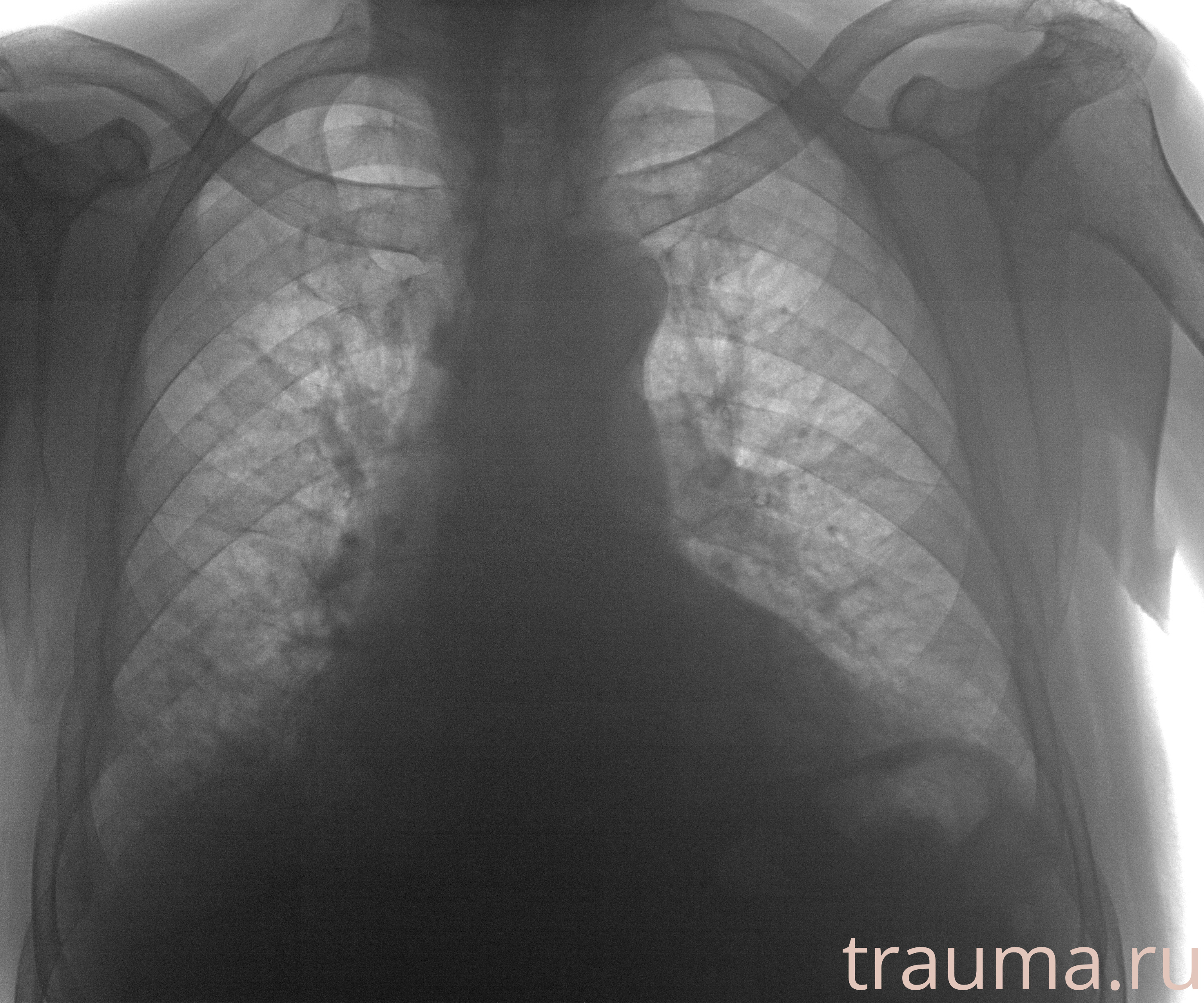 Рентген на дому: по вашему адресу приезжает врач-рентгенолог, травматолог-ортопед с мобильным рентгеновским аппаратом, проводит диагностику травмы или заболевания, делает необходимые рентгенограммы, дает рекомендации по дальнейшему лечению. Получить качественные снимки в домашних условиях возможно благодаря уникальной методике, разработанной МосРентген Центром для института  Склифосовского