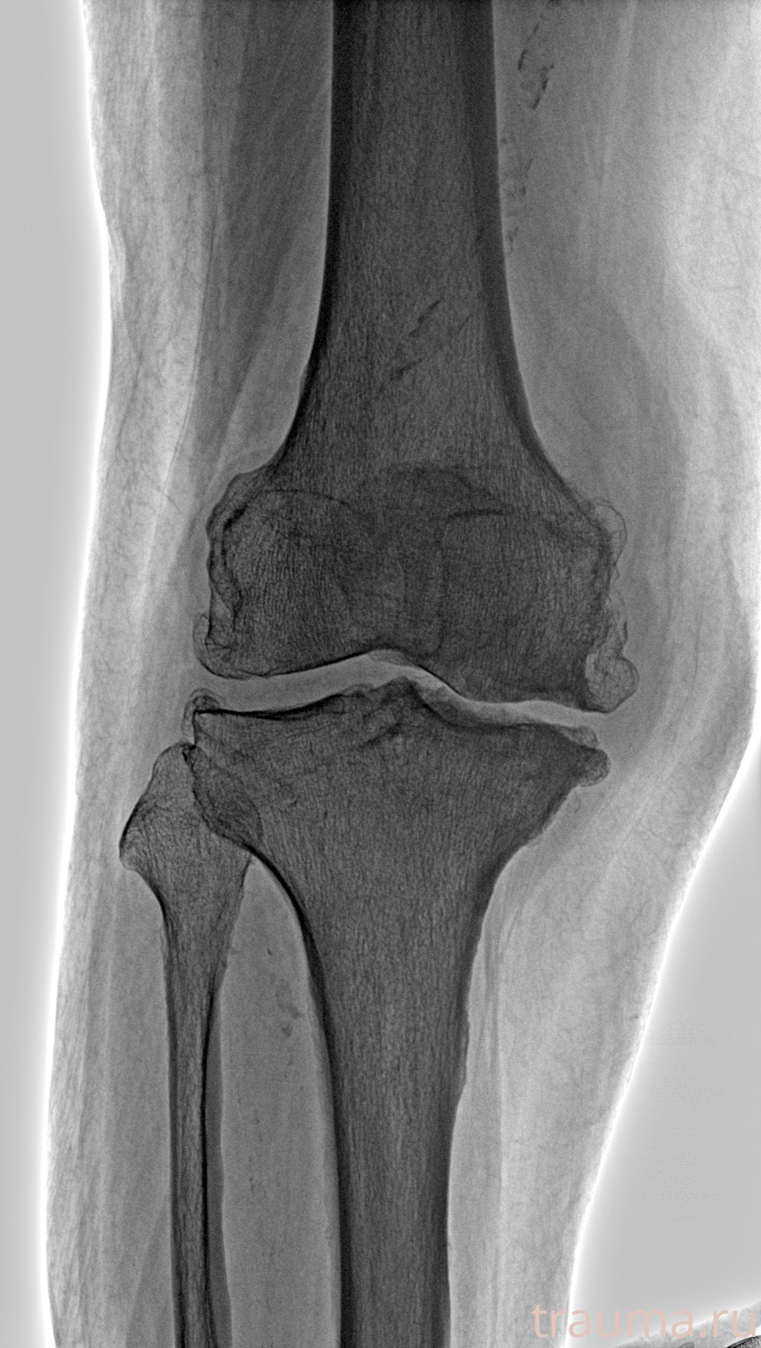 Рентген на дому: по вашему адресу приезжает врач-рентгенолог, травматолог-ортопед с мобильным рентгеновским аппаратом, проводит диагностику травмы или заболевания, делает необходимые рентгенограммы, дает рекомендации по дальнейшему лечению. Получить качественные снимки в домашних условиях возможно благодаря уникальной методике, разработанной МосРентген Центром для института  Склифосовского