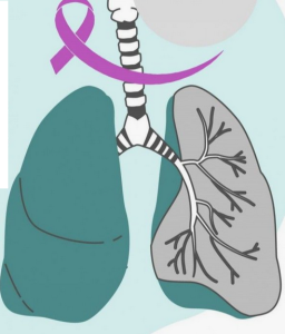 Проблемы и достижения в лечении рака легких Проблемы и достижения в лечении рака легких