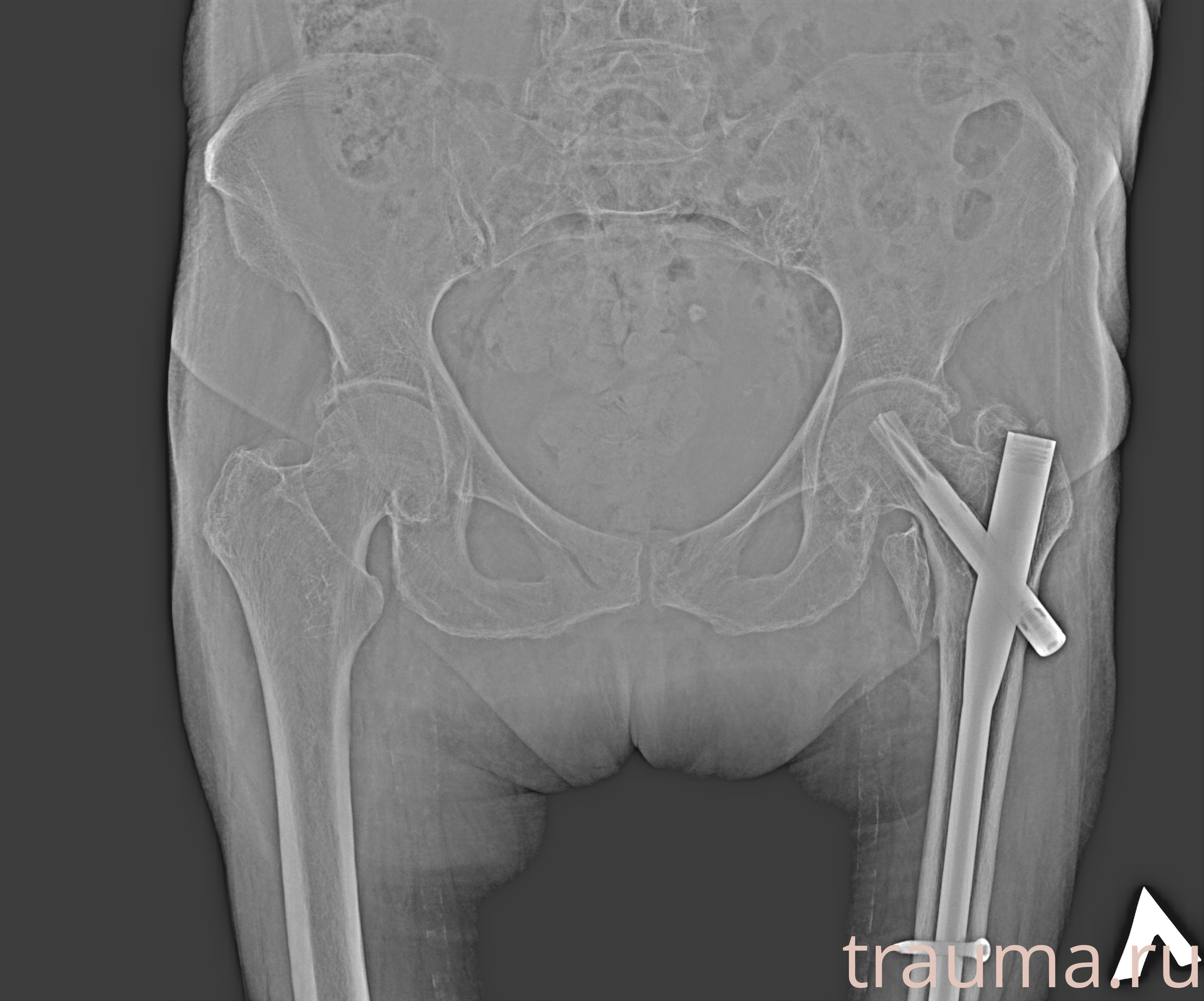 Рентген на дому: по вашему адресу приезжает врач-рентгенолог, травматолог-ортопед с мобильным рентгеновским аппаратом, проводит диагностику травмы или заболевания, делает необходимые рентгенограммы, дает рекомендации по дальнейшему лечению. Получить качественные снимки в домашних условиях возможно благодаря уникальной методике, разработанной МосРентген Центром для института  Склифосовского