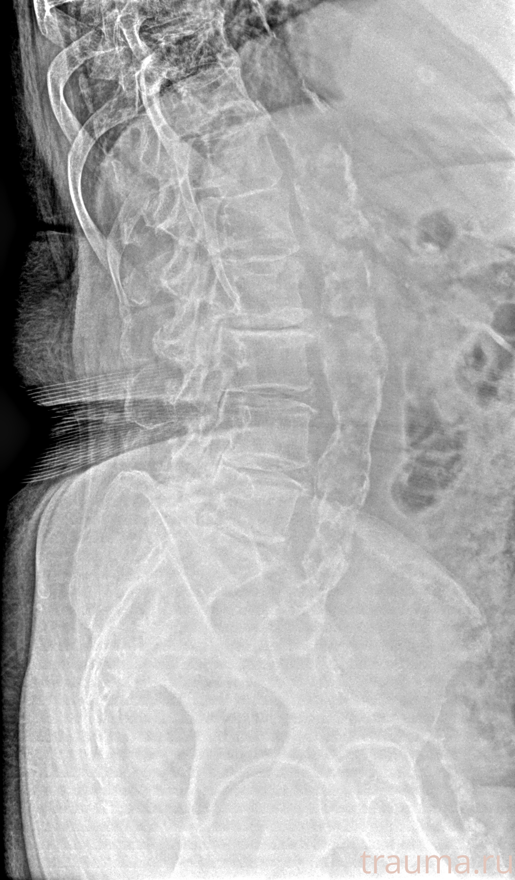 Рентген на дому: по вашему адресу приезжает врач-рентгенолог, травматолог-ортопед с мобильным рентгеновским аппаратом, проводит диагностику травмы или заболевания, делает необходимые рентгенограммы, дает рекомендации по дальнейшему лечению. Получить качественные снимки в домашних условиях возможно благодаря уникальной методике, разработанной МосРентген Центром для института  Склифосовского