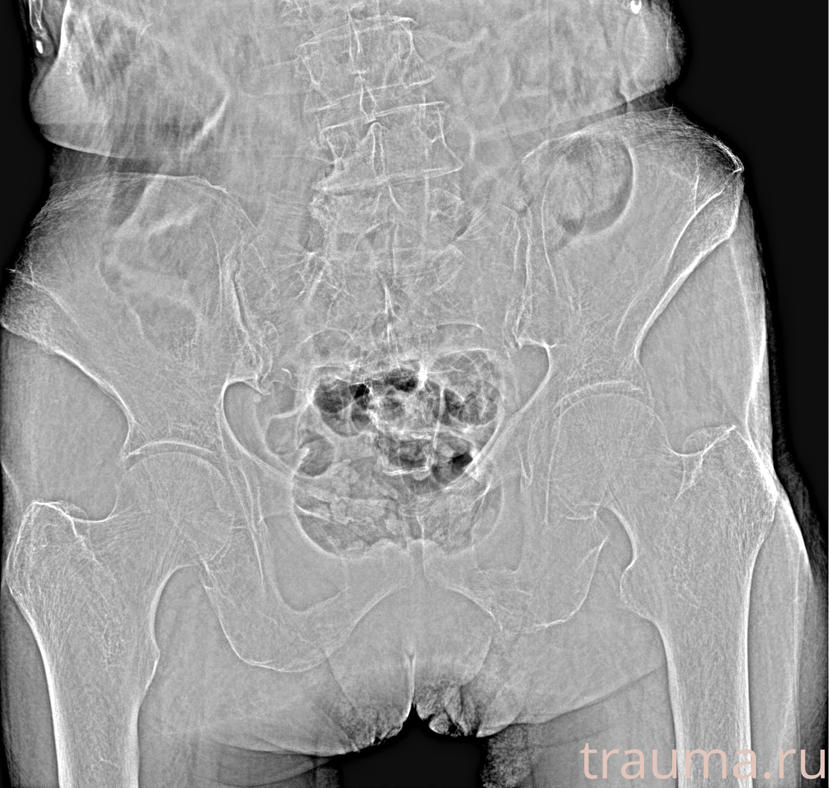 Рентген на дому: по вашему адресу приезжает врач-рентгенолог, травматолог-ортопед с мобильным рентгеновским аппаратом, проводит диагностику травмы или заболевания, делает необходимые рентгенограммы, дает рекомендации по дальнейшему лечению. Получить качественные снимки в домашних условиях возможно благодаря уникальной методике, разработанной МосРентген Центром для института  Склифосовского