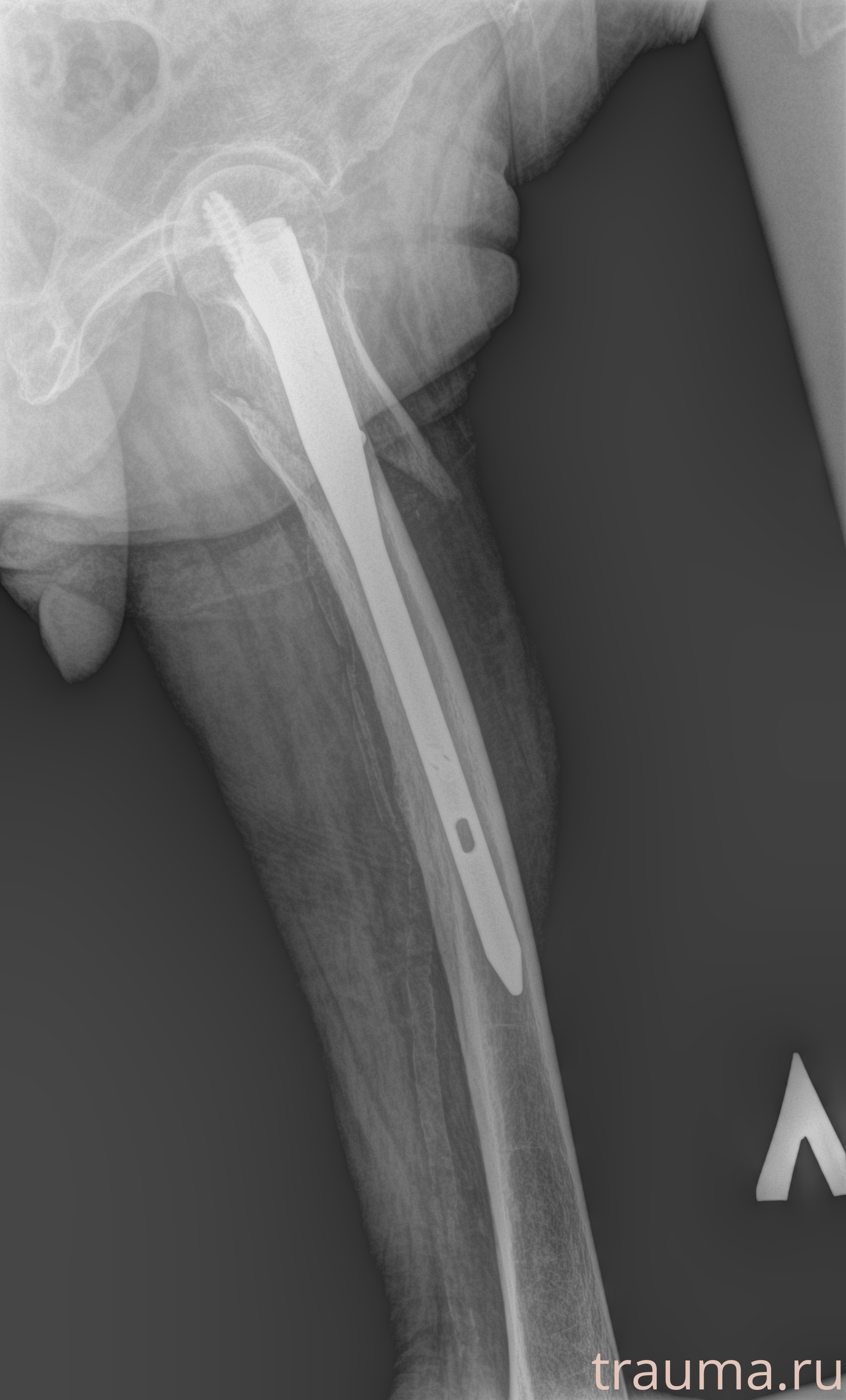 Рентген на дому: по вашему адресу приезжает врач-рентгенолог, травматолог-ортопед с мобильным рентгеновским аппаратом, проводит диагностику травмы или заболевания, делает необходимые рентгенограммы, дает рекомендации по дальнейшему лечению. Получить качественные снимки в домашних условиях возможно благодаря уникальной методике, разработанной МосРентген Центром для института  Склифосовского