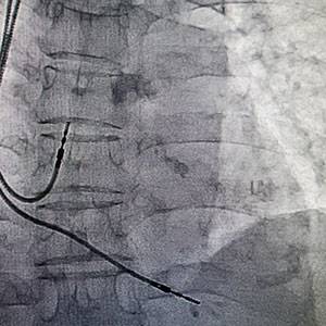 Рентген-ангиографическая установка Siemens Artis Zee Рентген-ангиографическая установка Siemens Artis Zee