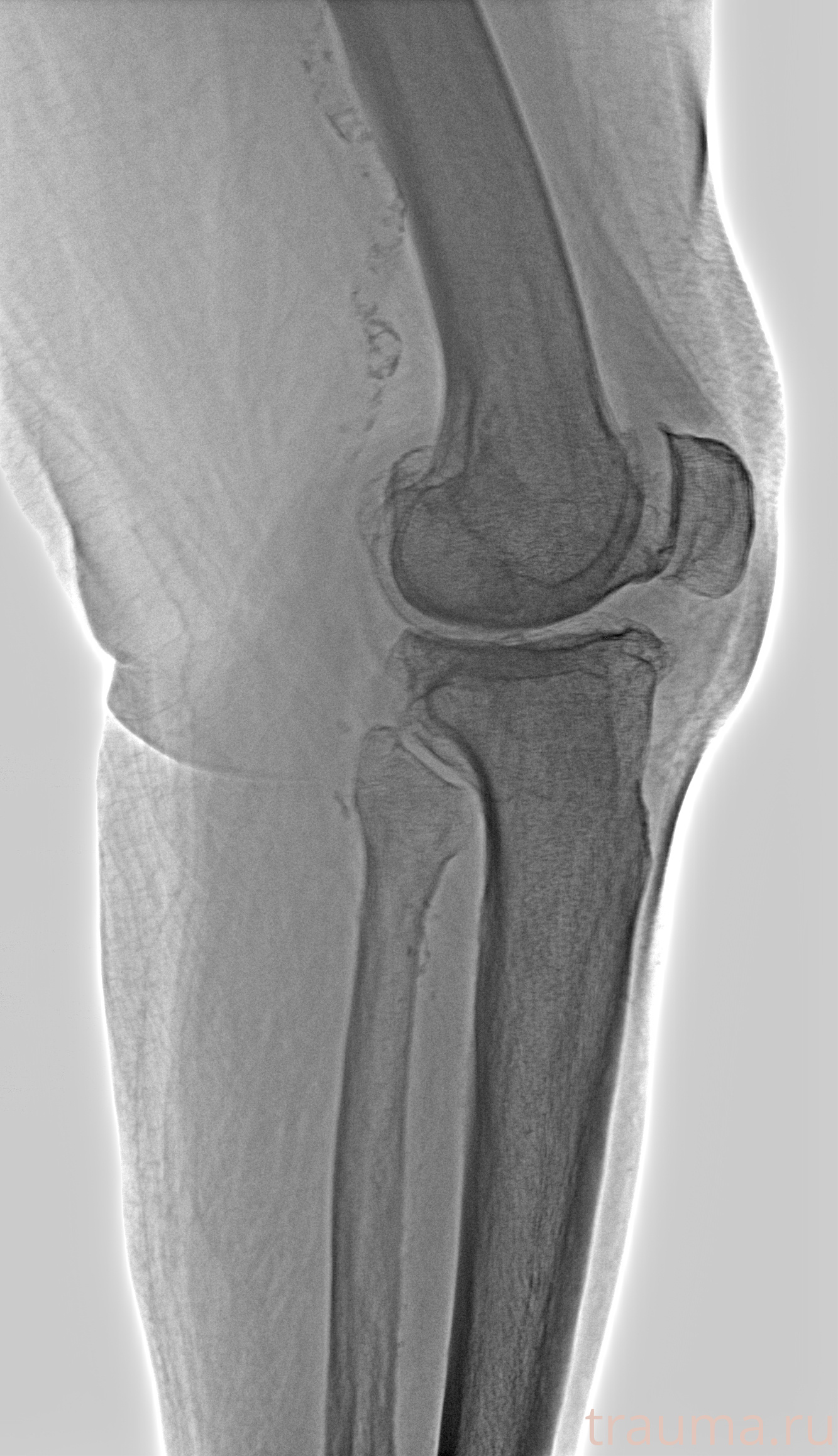 Рентген на дому: по вашему адресу приезжает врач-рентгенолог, травматолог-ортопед с мобильным рентгеновским аппаратом, проводит диагностику травмы или заболевания, делает необходимые рентгенограммы, дает рекомендации по дальнейшему лечению. Получить качественные снимки в домашних условиях возможно благодаря уникальной методике, разработанной МосРентген Центром для института  Склифосовского