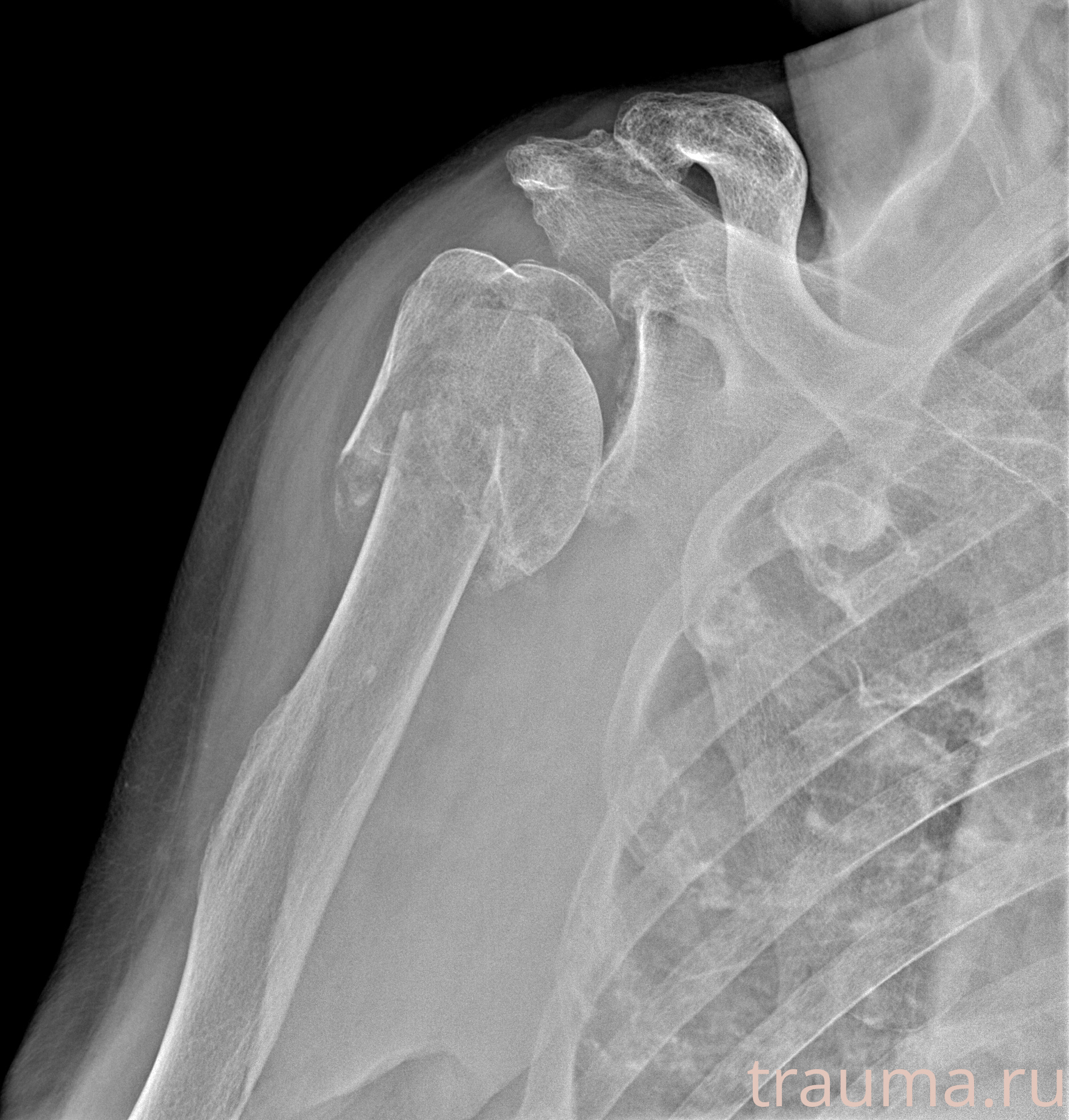 Рентген на дому: по вашему адресу приезжает врач-рентгенолог, травматолог-ортопед с мобильным рентгеновским аппаратом, проводит диагностику травмы или заболевания, делает необходимые рентгенограммы, дает рекомендации по дальнейшему лечению. Получить качественные снимки в домашних условиях возможно благодаря уникальной методике, разработанной МосРентген Центром для института  Склифосовского