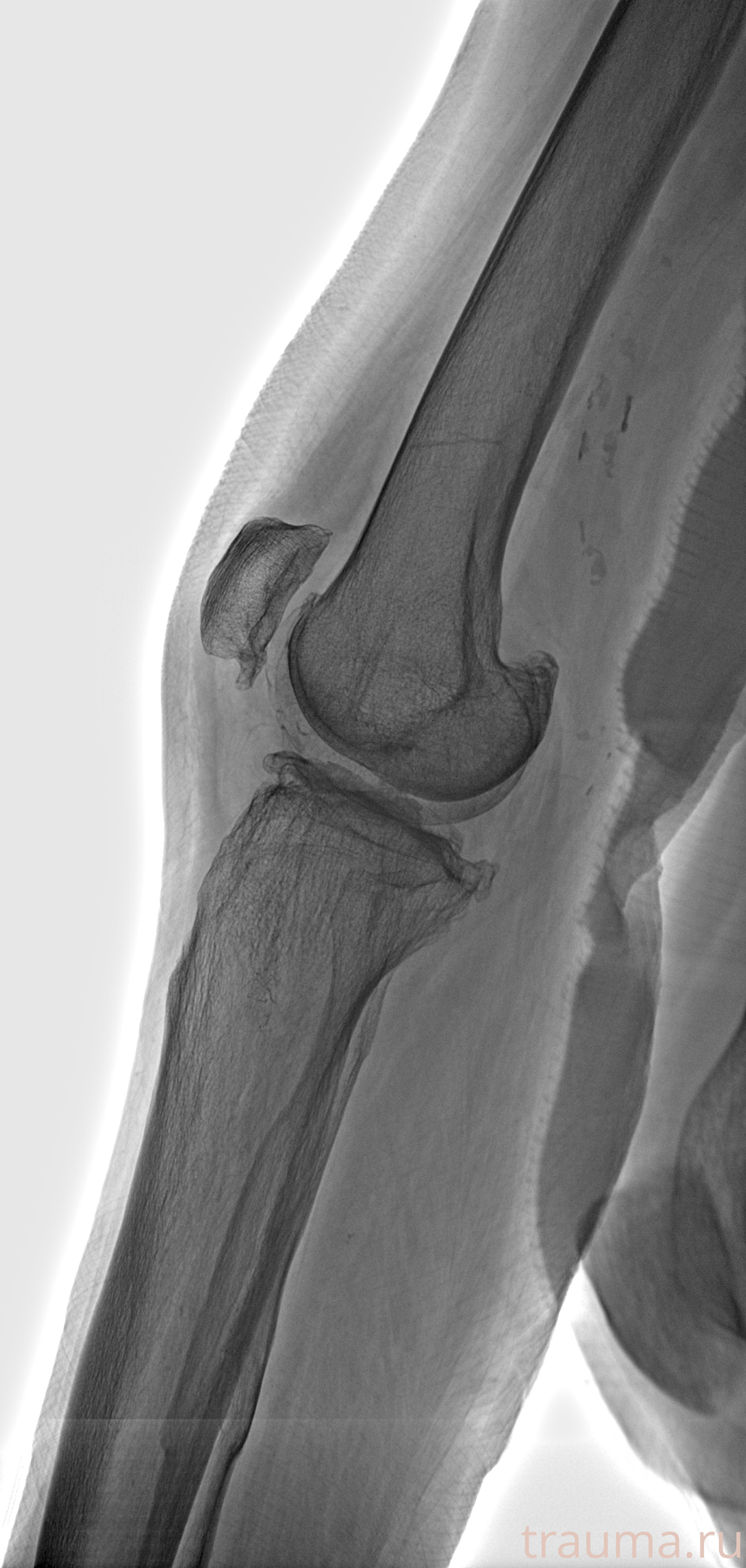 Рентген на дому: по вашему адресу приезжает врач-рентгенолог, травматолог-ортопед с мобильным рентгеновским аппаратом, проводит диагностику травмы или заболевания, делает необходимые рентгенограммы, дает рекомендации по дальнейшему лечению. Получить качественные снимки в домашних условиях возможно благодаря уникальной методике, разработанной МосРентген Центром для института  Склифосовского