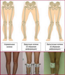 Моделирование формы нижних конечностей у пациентов с варусной деформацией голеней Моделирование формы нижних конечностей у пациентов с варусной деформацией голеней