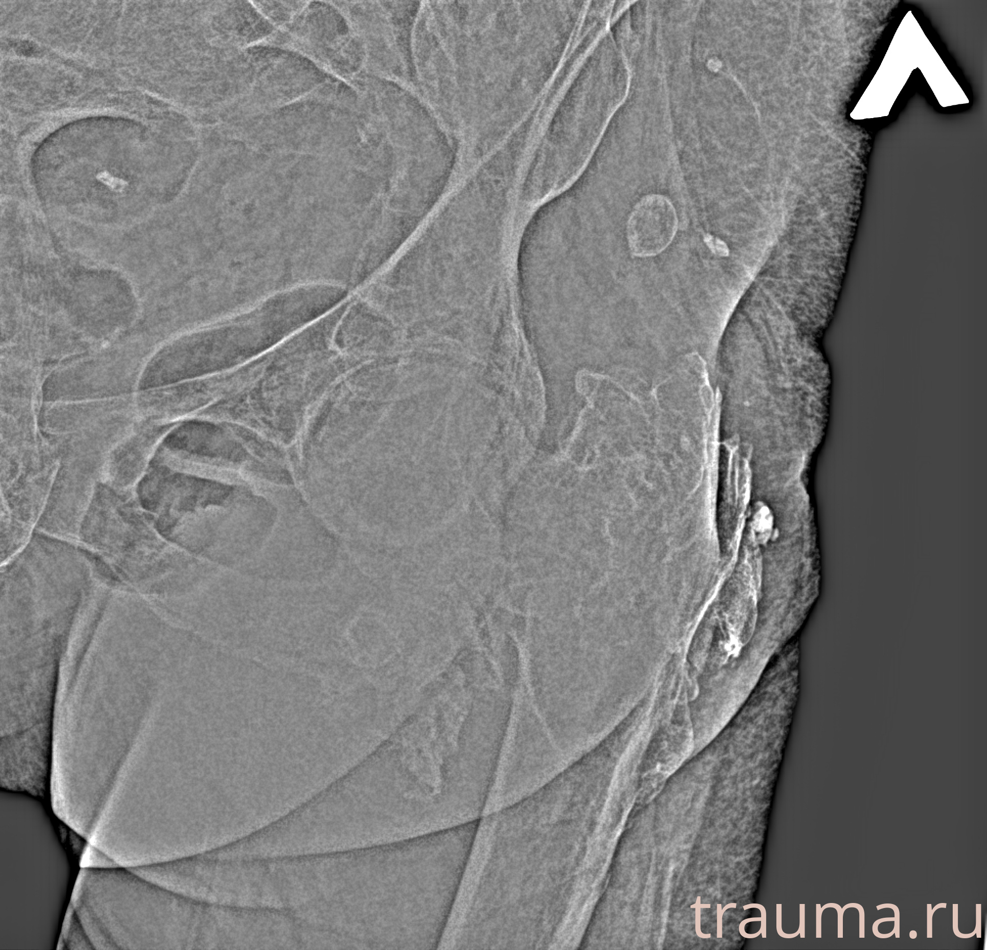 Рентген на дому: по вашему адресу приезжает врач-рентгенолог, травматолог-ортопед с мобильным рентгеновским аппаратом, проводит диагностику травмы или заболевания, делает необходимые рентгенограммы, дает рекомендации по дальнейшему лечению. Получить качественные снимки в домашних условиях возможно благодаря уникальной методике, разработанной МосРентген Центром для института  Склифосовского