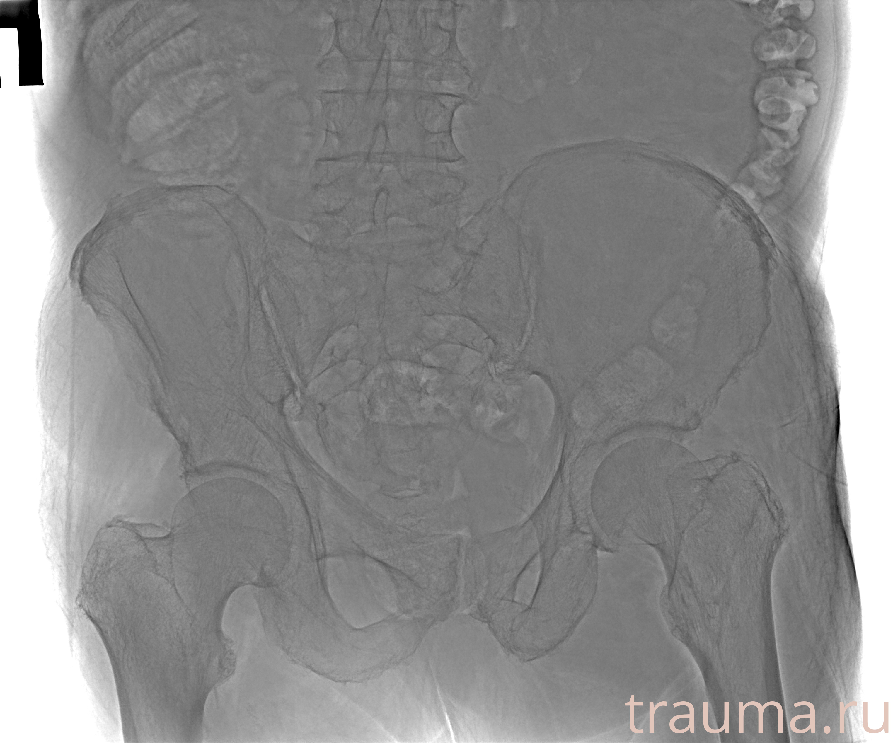 Рентген на дому: по вашему адресу приезжает врач-рентгенолог, травматолог-ортопед с мобильным рентгеновским аппаратом, проводит диагностику травмы или заболевания, делает необходимые рентгенограммы, дает рекомендации по дальнейшему лечению. Получить качественные снимки в домашних условиях возможно благодаря уникальной методике, разработанной МосРентген Центром для института  Склифосовского