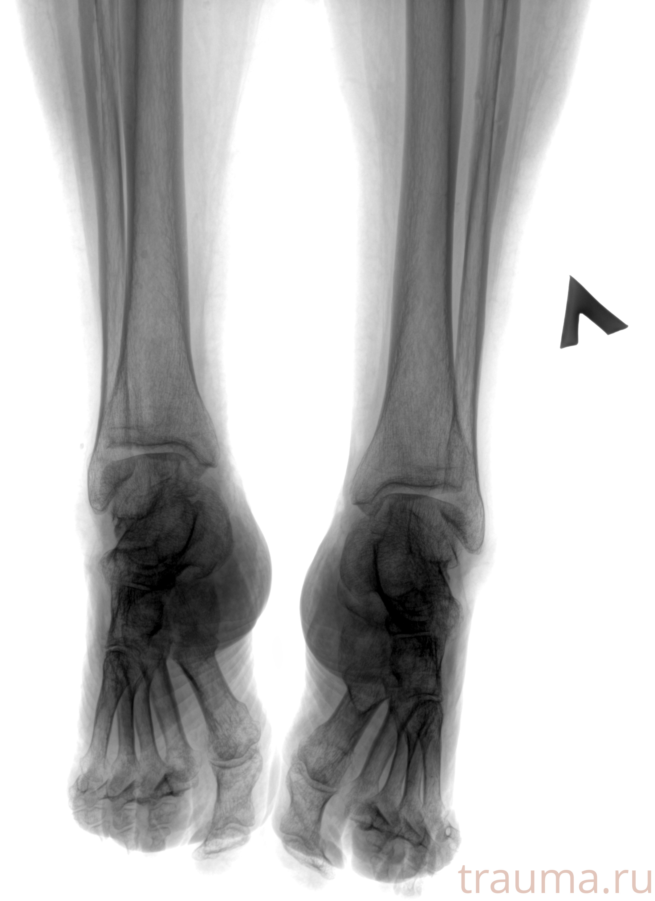 Рентген на дому: по вашему адресу приезжает врач-рентгенолог, травматолог-ортопед с мобильным рентгеновским аппаратом, проводит диагностику травмы или заболевания, делает необходимые рентгенограммы, дает рекомендации по дальнейшему лечению. Получить качественные снимки в домашних условиях возможно благодаря уникальной методике, разработанной МосРентген Центром для института  Склифосовского