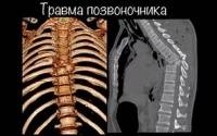 Способ КТ-контроля положения стержней при транспедикулярной фиксации переломов позвоночника Способ КТ-контроля положения стержней при транспедикулярной фиксации переломов позвоночника