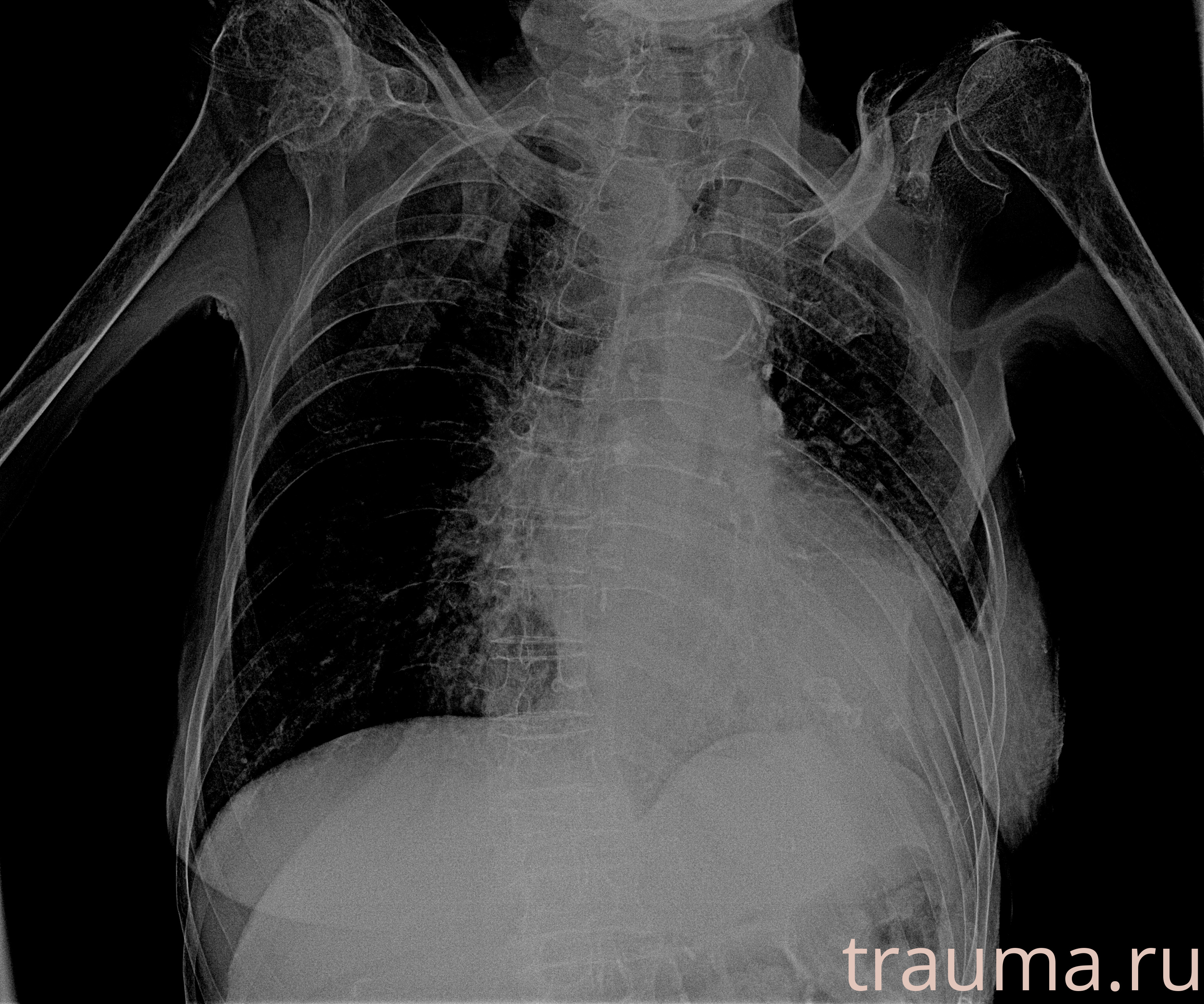 Рентген на дому: по вашему адресу приезжает врач-рентгенолог, травматолог-ортопед с мобильным рентгеновским аппаратом, проводит диагностику травмы или заболевания, делает необходимые рентгенограммы, дает рекомендации по дальнейшему лечению. Получить качественные снимки в домашних условиях возможно благодаря уникальной методике, разработанной МосРентген Центром для института  Склифосовского