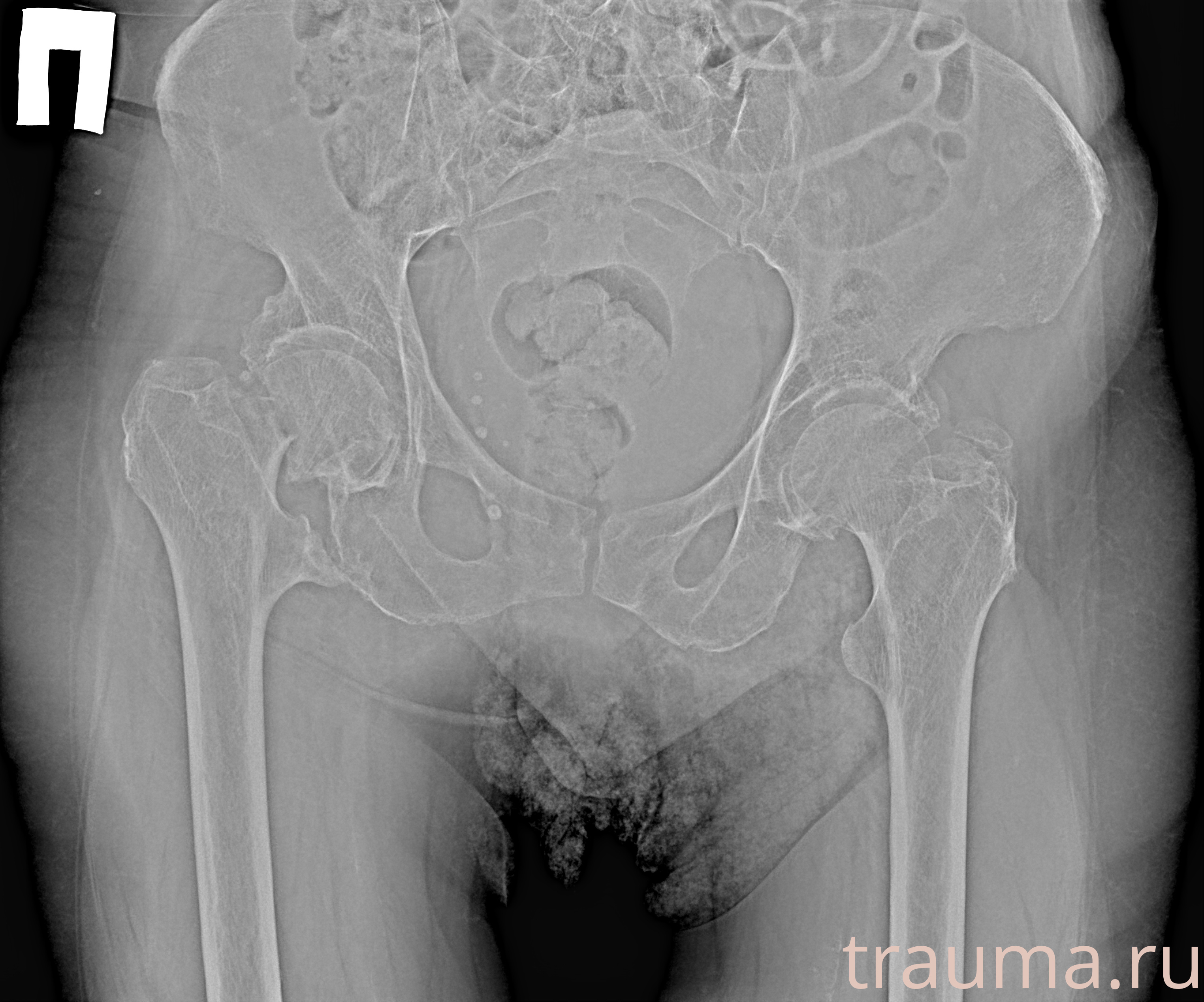 Рентген на дому: по вашему адресу приезжает врач-рентгенолог, травматолог-ортопед с мобильным рентгеновским аппаратом, проводит диагностику травмы или заболевания, делает необходимые рентгенограммы, дает рекомендации по дальнейшему лечению. Получить качественные снимки в домашних условиях возможно благодаря уникальной методике, разработанной МосРентген Центром для института  Склифосовского