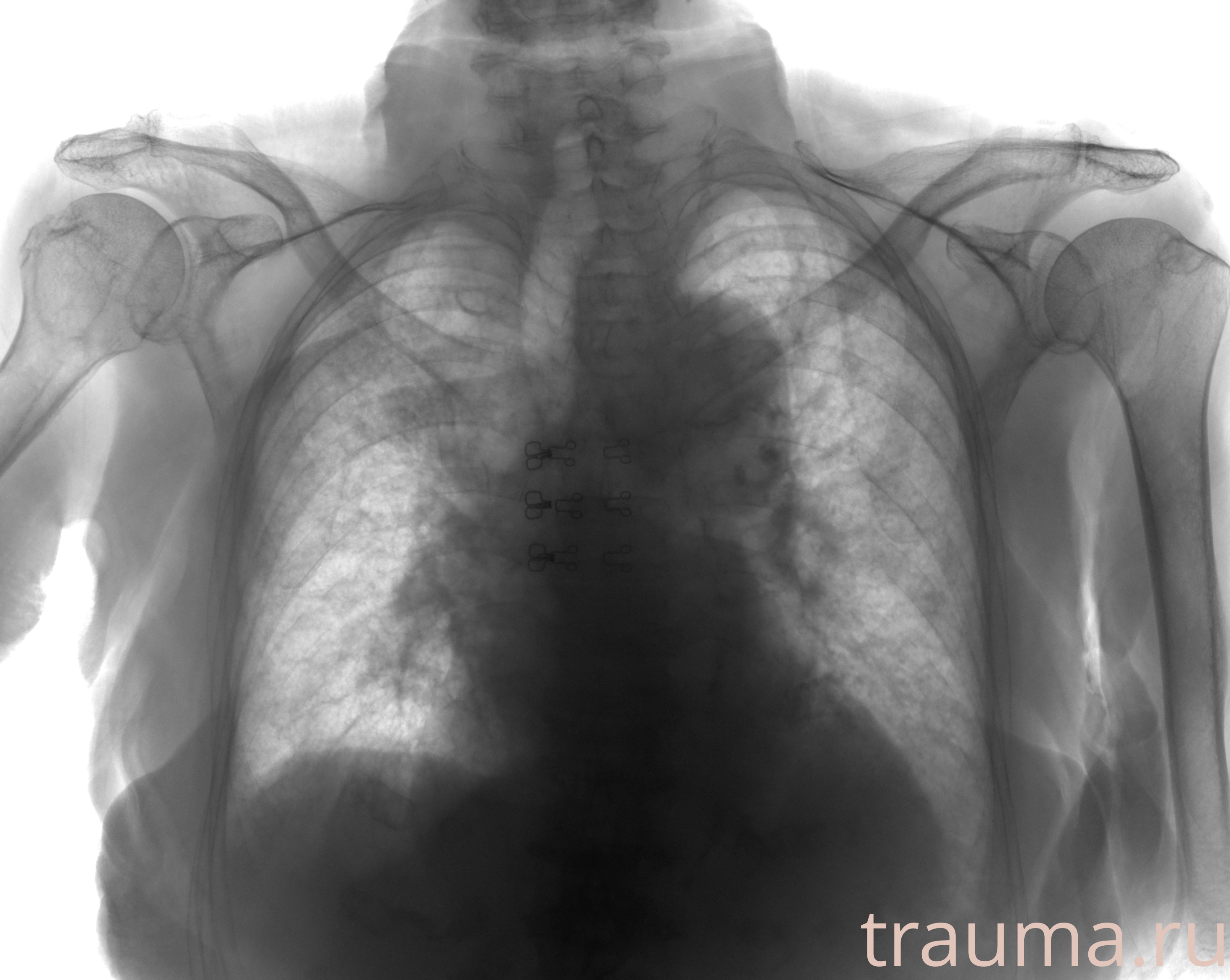 Рентген на дому: по вашему адресу приезжает врач-рентгенолог, травматолог-ортопед с мобильным рентгеновским аппаратом, проводит диагностику травмы или заболевания, делает необходимые рентгенограммы, дает рекомендации по дальнейшему лечению. Получить качественные снимки в домашних условиях возможно благодаря уникальной методике, разработанной МосРентген Центром для института  Склифосовского