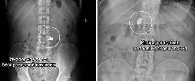 Всё это «достали из пациентов» врачи Склифа в 2025 году 