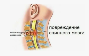 Особенности повреждений   позвоночника и спинного мозга
 
