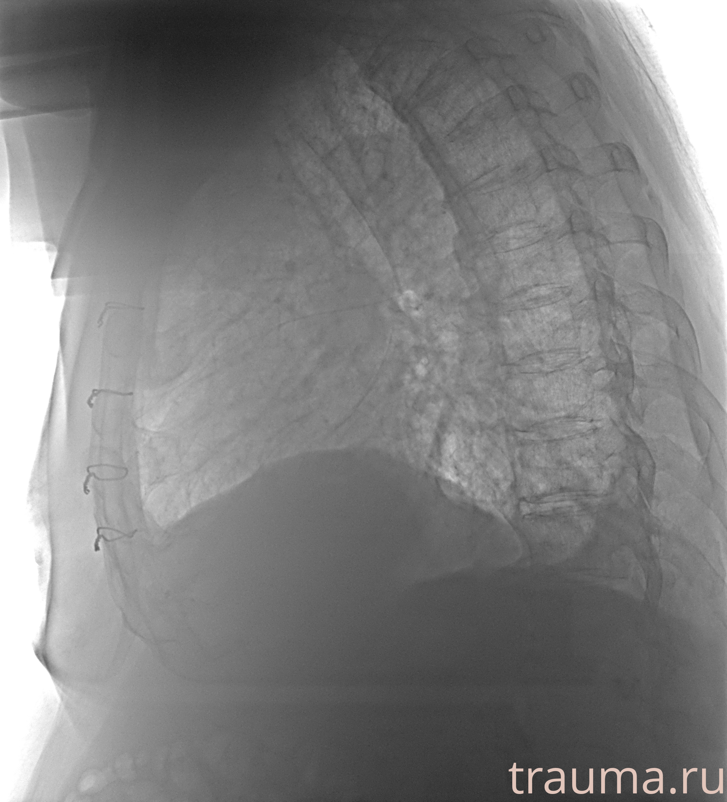 Рентген на дому: по вашему адресу приезжает врач-рентгенолог, травматолог-ортопед с мобильным рентгеновским аппаратом, проводит диагностику травмы или заболевания, делает необходимые рентгенограммы, дает рекомендации по дальнейшему лечению. Получить качественные снимки в домашних условиях возможно благодаря уникальной методике, разработанной МосРентген Центром для института  Склифосовского