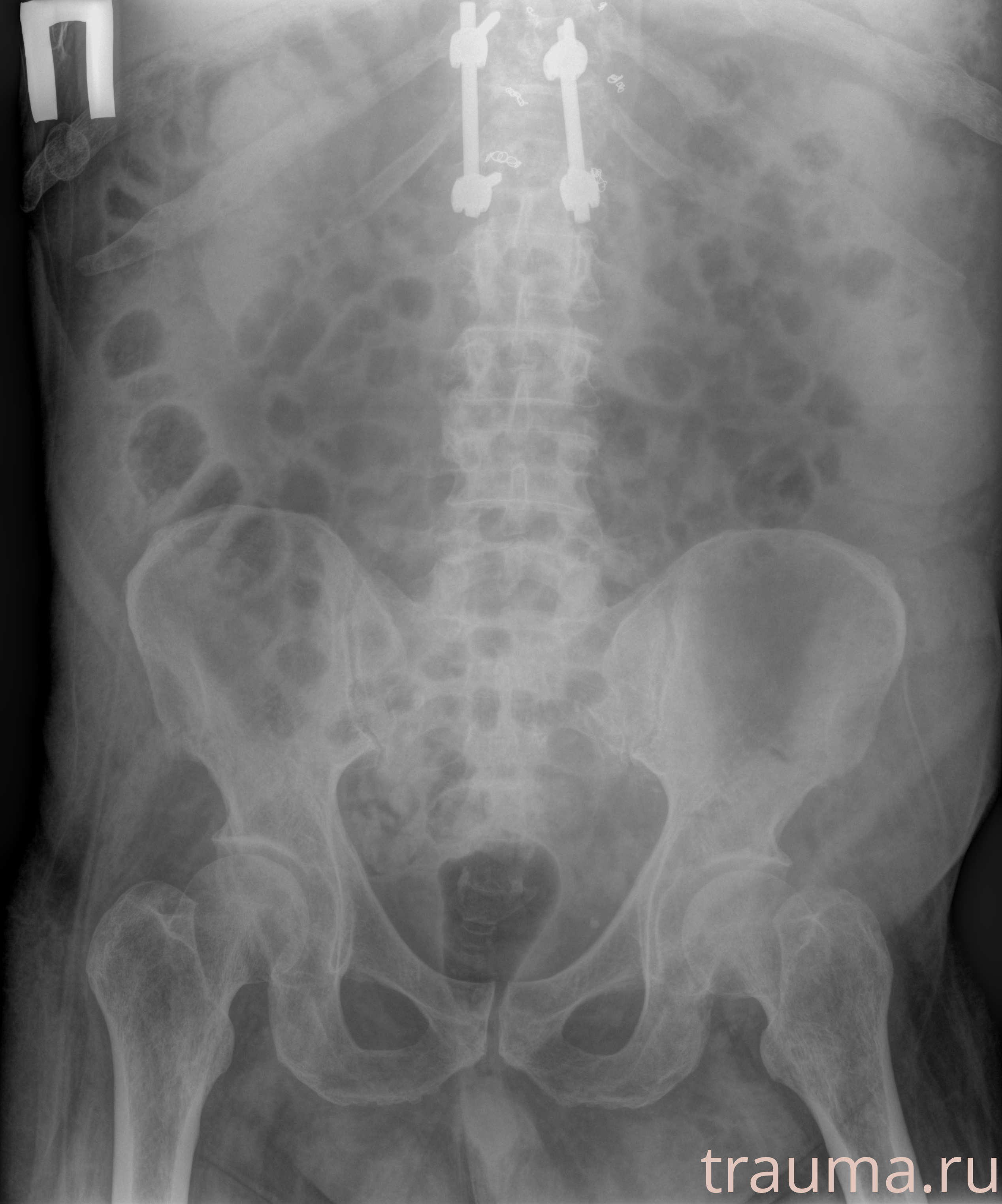 Рентген на дому: по вашему адресу приезжает врач-рентгенолог, травматолог-ортопед с мобильным рентгеновским аппаратом, проводит диагностику травмы или заболевания, делает необходимые рентгенограммы, дает рекомендации по дальнейшему лечению. Получить качественные снимки в домашних условиях возможно благодаря уникальной методике, разработанной МосРентген Центром для института  Склифосовского