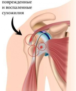 Эндопротезирование плечевого сустава Эндопротезирование плечевого сустава