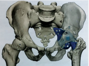 Определение границ «стенок вертлужной впадины» в рамках эндопротезирования тазобедренного сустава