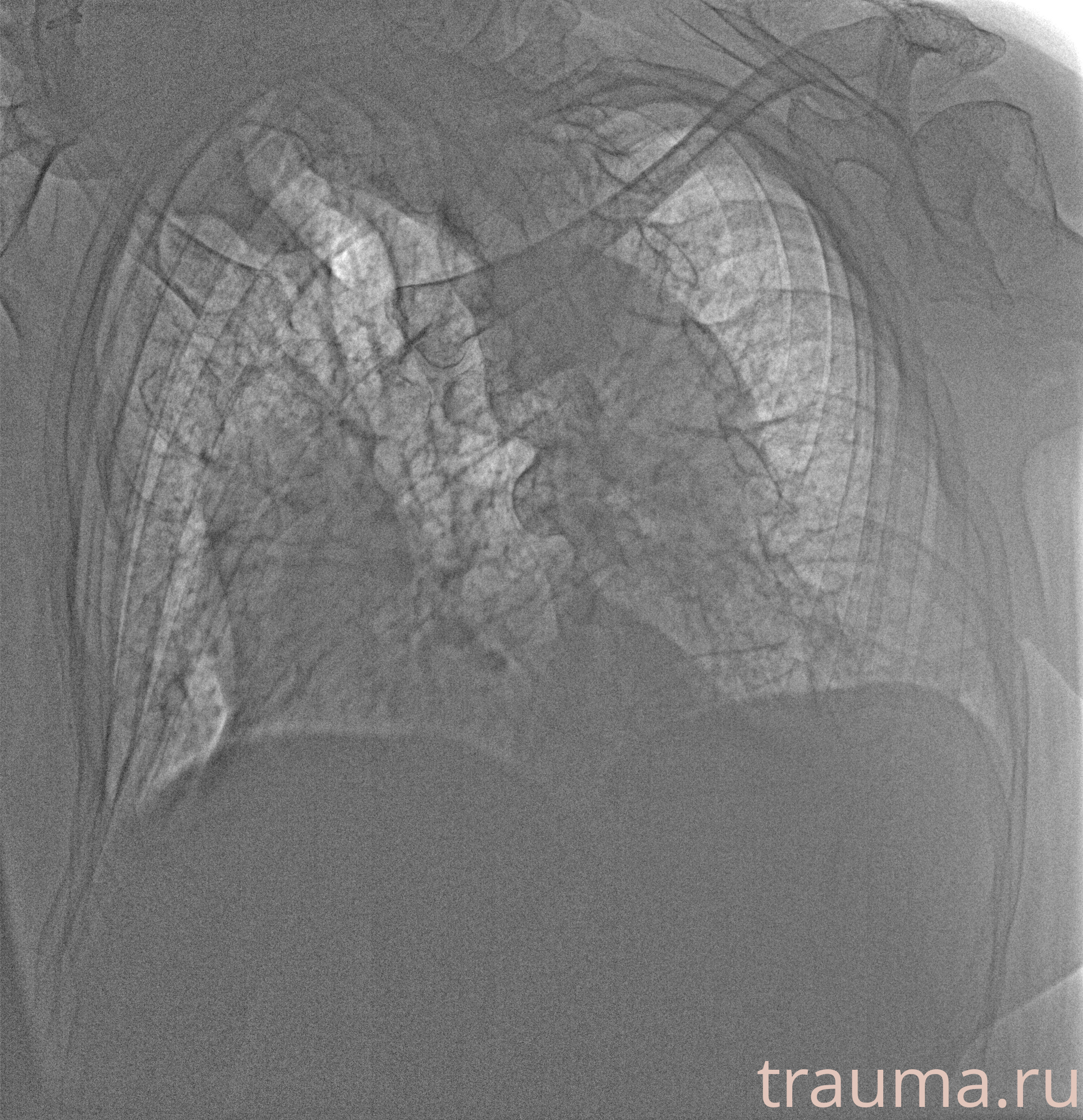 Рентген на дому: по вашему адресу приезжает врач-рентгенолог, травматолог-ортопед с мобильным рентгеновским аппаратом, проводит диагностику травмы или заболевания, делает необходимые рентгенограммы, дает рекомендации по дальнейшему лечению. Получить качественные снимки в домашних условиях возможно благодаря уникальной методике, разработанной МосРентген Центром для института  Склифосовского
