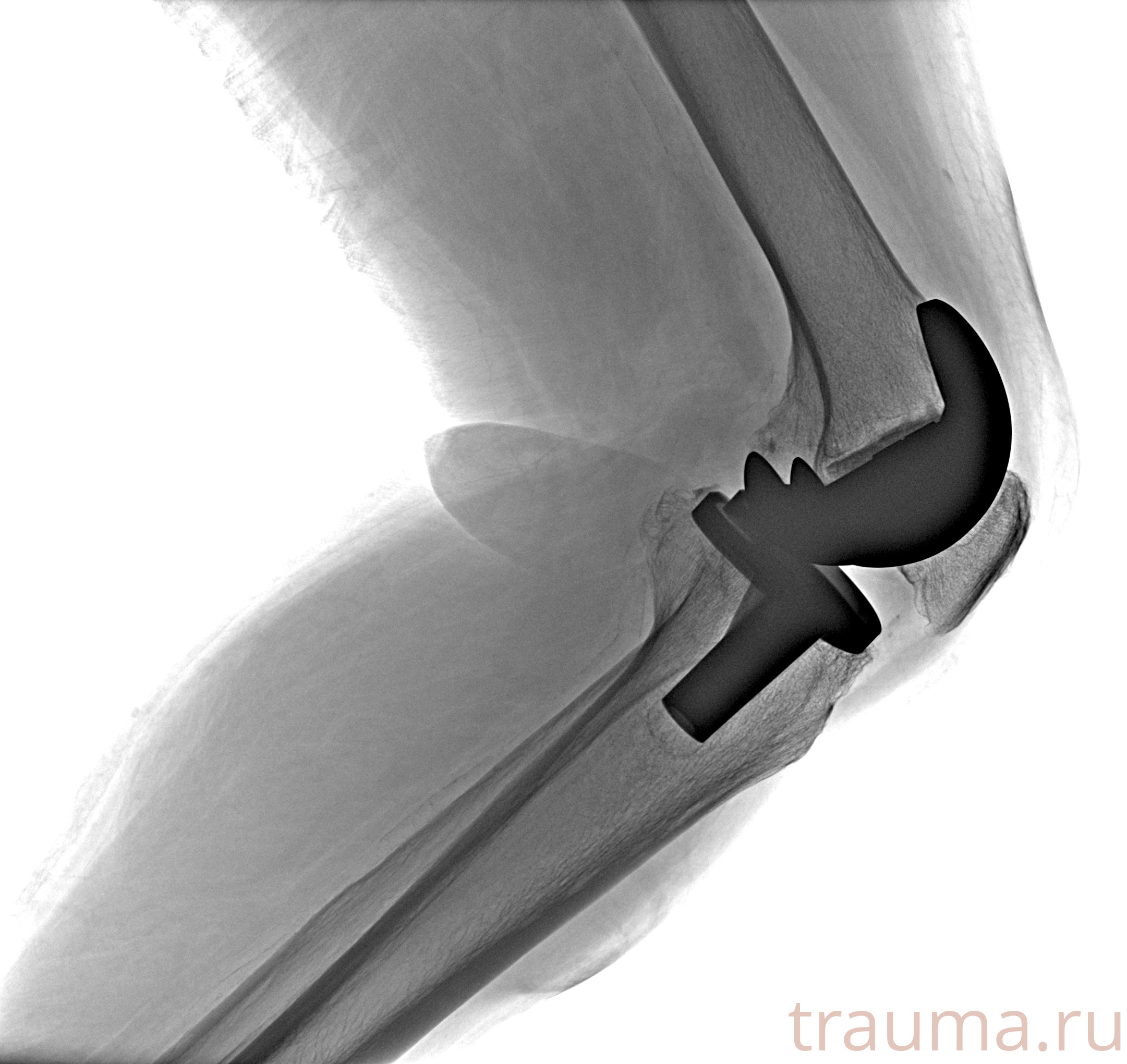 Рентген на дому: по вашему адресу приезжает врач-рентгенолог, травматолог-ортопед с мобильным рентгеновским аппаратом, проводит диагностику травмы или заболевания, делает необходимые рентгенограммы, дает рекомендации по дальнейшему лечению. Получить качественные снимки в домашних условиях возможно благодаря уникальной методике, разработанной МосРентген Центром для института  Склифосовского