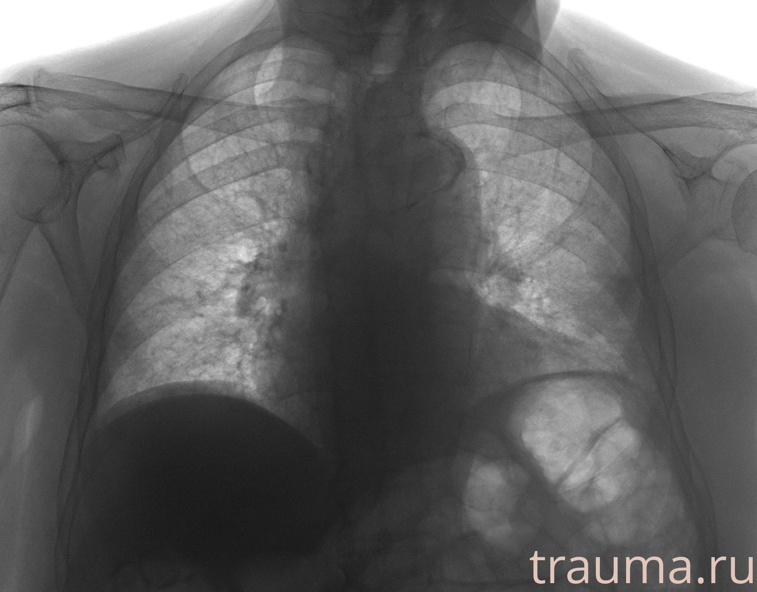 Рентген на дому: по вашему адресу приезжает врач-рентгенолог, травматолог-ортопед с мобильным рентгеновским аппаратом, проводит диагностику травмы или заболевания, делает необходимые рентгенограммы, дает рекомендации по дальнейшему лечению. Получить качественные снимки в домашних условиях возможно благодаря уникальной методике, разработанной МосРентген Центром для института  Склифосовского