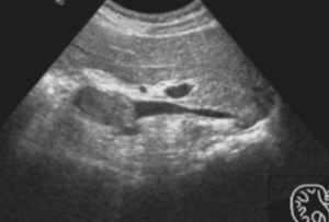 Ультразвуковая семиотика опухолевого тромбоза  лейомисаркомы нижней полой вены: проспективное исследование  