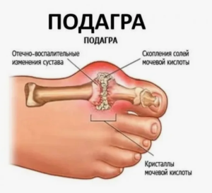 Идиопатическая подагра Идиопатическая подагра