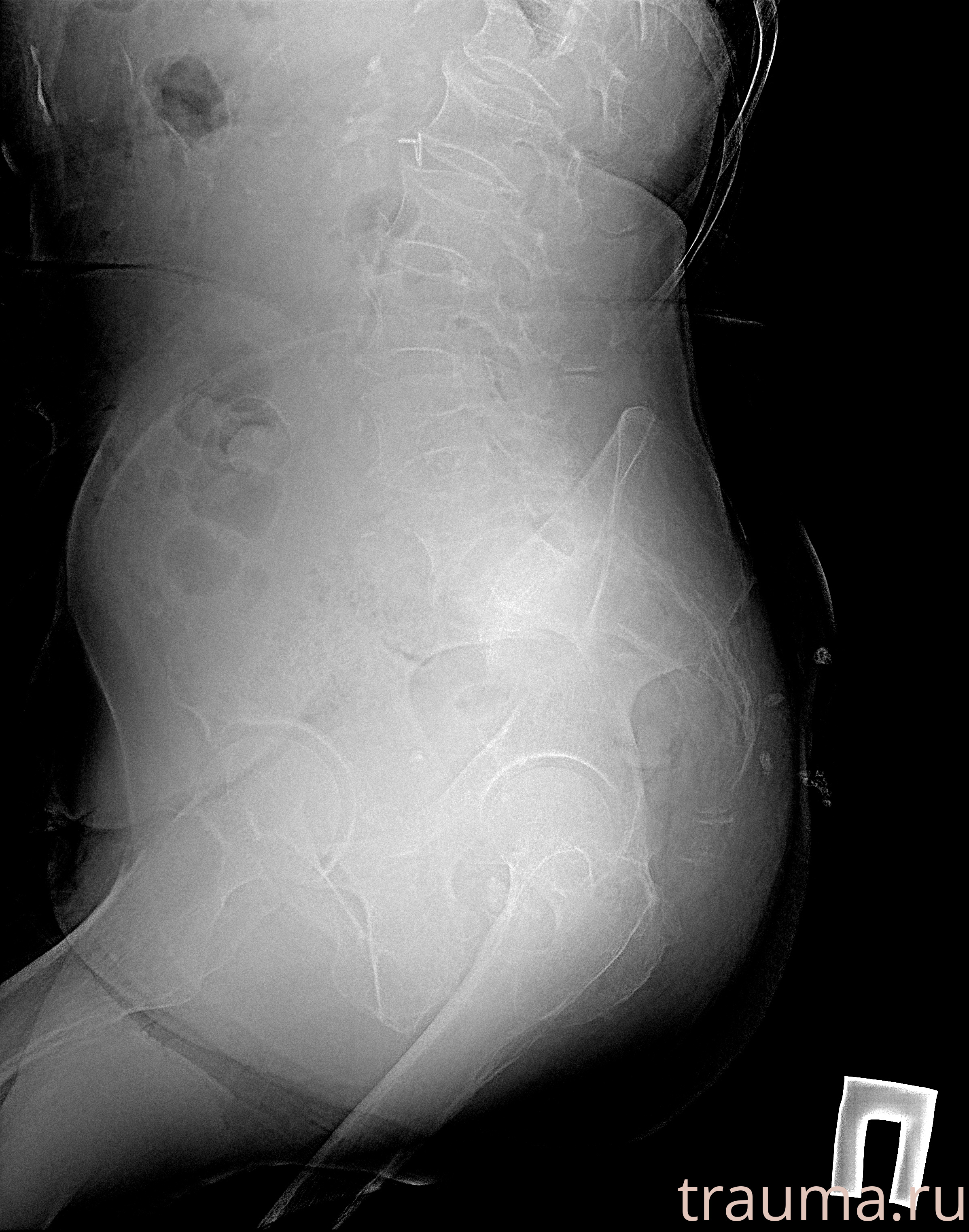 Рентген на дому: по вашему адресу приезжает врач-рентгенолог, травматолог-ортопед с мобильным рентгеновским аппаратом, проводит диагностику травмы или заболевания, делает необходимые рентгенограммы, дает рекомендации по дальнейшему лечению. Получить качественные снимки в домашних условиях возможно благодаря уникальной методике, разработанной МосРентген Центром для института  Склифосовского