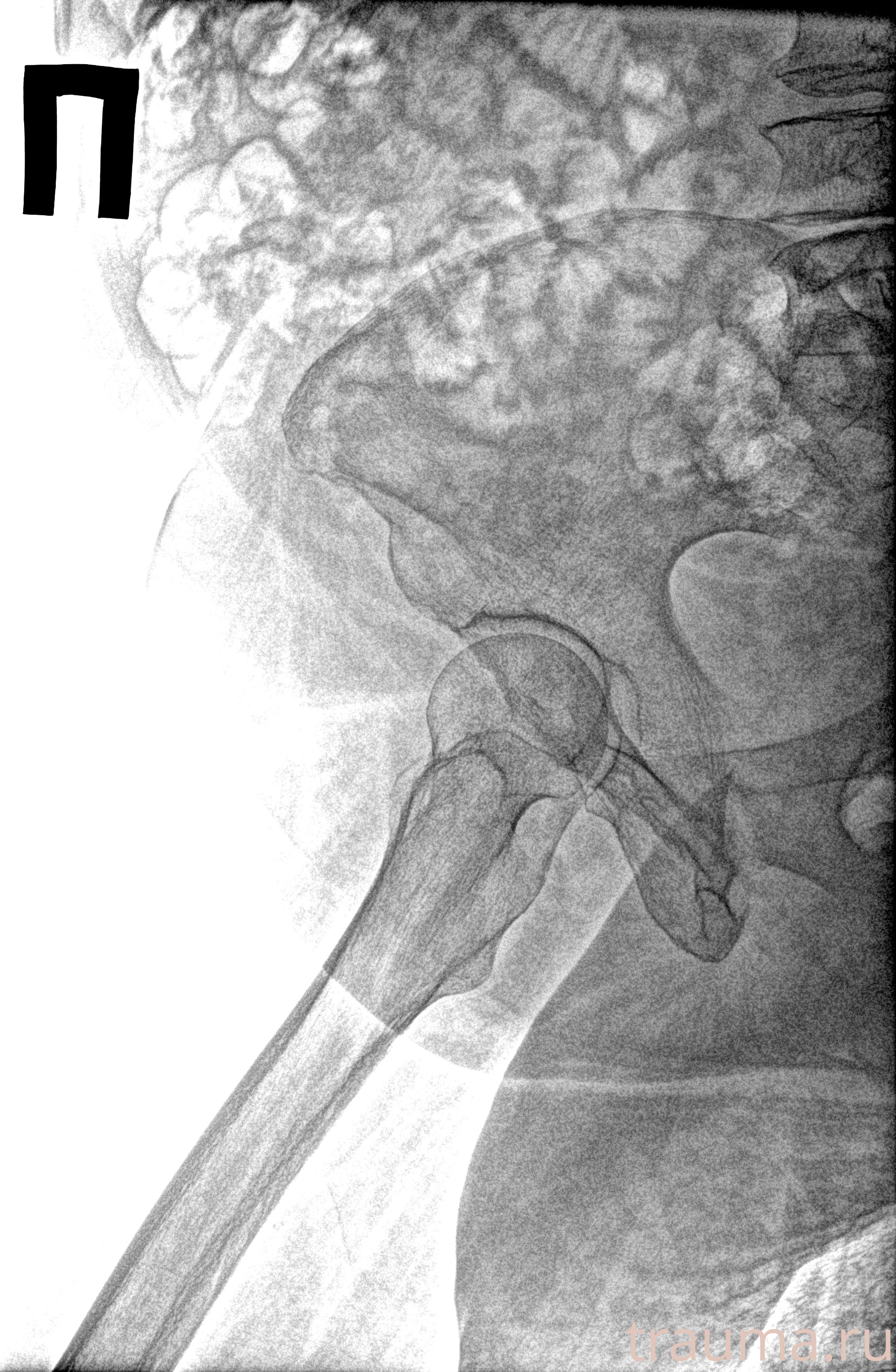 Рентген на дому: по вашему адресу приезжает врач-рентгенолог, травматолог-ортопед с мобильным рентгеновским аппаратом, проводит диагностику травмы или заболевания, делает необходимые рентгенограммы, дает рекомендации по дальнейшему лечению. Получить качественные снимки в домашних условиях возможно благодаря уникальной методике, разработанной МосРентген Центром для института  Склифосовского