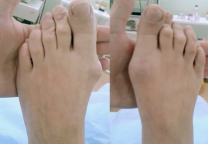 Клинико-исторические аспекты лечения HALLUX VALGUS (часть I) Клинико-исторические аспекты лечения HALLUX VALGUS (часть I)