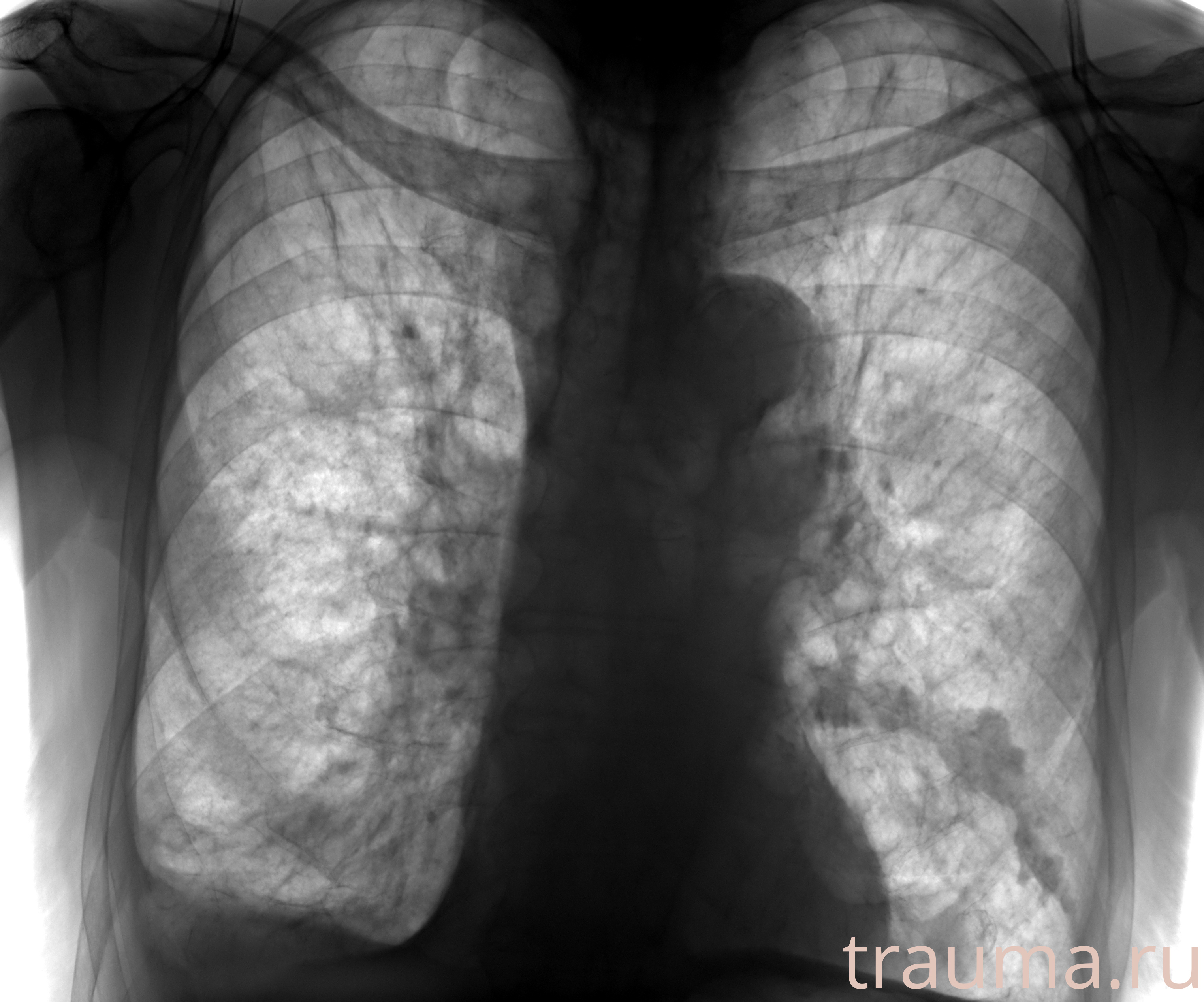 Рентген на дому: по вашему адресу приезжает врач-рентгенолог, травматолог-ортопед с мобильным рентгеновским аппаратом, проводит диагностику травмы или заболевания, делает необходимые рентгенограммы, дает рекомендации по дальнейшему лечению. Получить качественные снимки в домашних условиях возможно благодаря уникальной методике, разработанной МосРентген Центром для института  Склифосовского