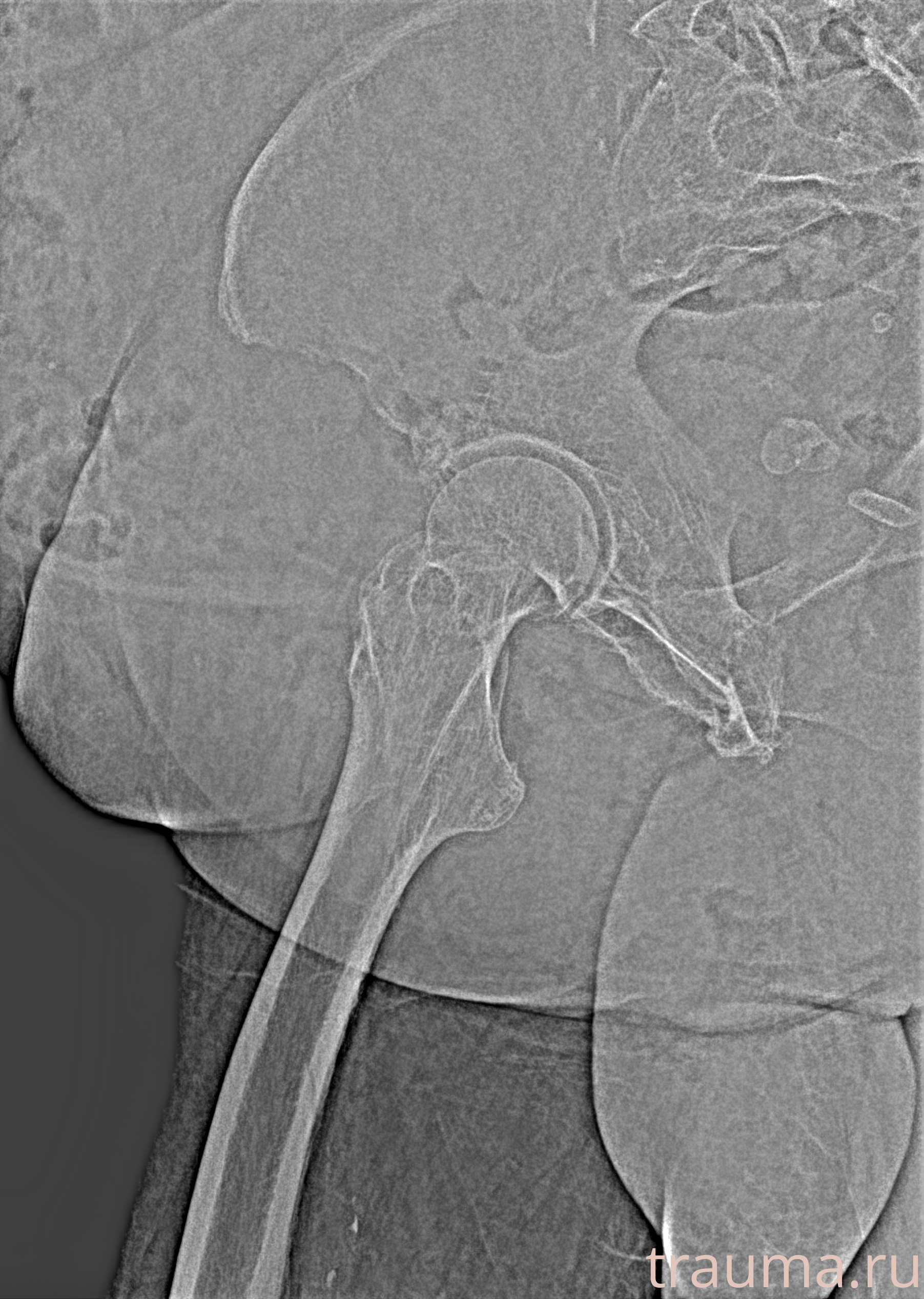 Рентген на дому: по вашему адресу приезжает врач-рентгенолог, травматолог-ортопед с мобильным рентгеновским аппаратом, проводит диагностику травмы или заболевания, делает необходимые рентгенограммы, дает рекомендации по дальнейшему лечению. Получить качественные снимки в домашних условиях возможно благодаря уникальной методике, разработанной МосРентген Центром для института  Склифосовского