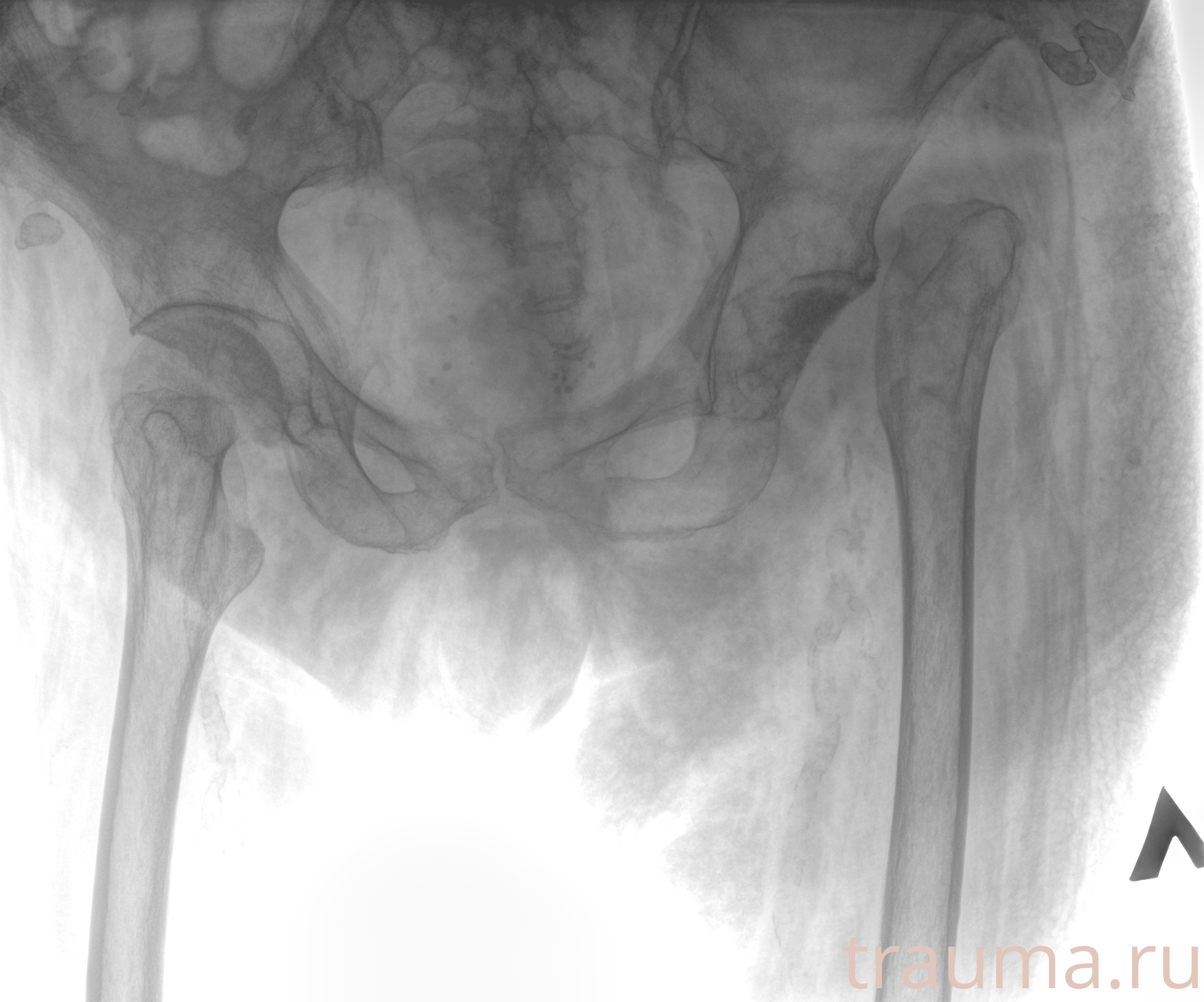 Рентген на дому: по вашему адресу приезжает врач-рентгенолог, травматолог-ортопед с мобильным рентгеновским аппаратом, проводит диагностику травмы или заболевания, делает необходимые рентгенограммы, дает рекомендации по дальнейшему лечению. Получить качественные снимки в домашних условиях возможно благодаря уникальной методике, разработанной МосРентген Центром для института  Склифосовского