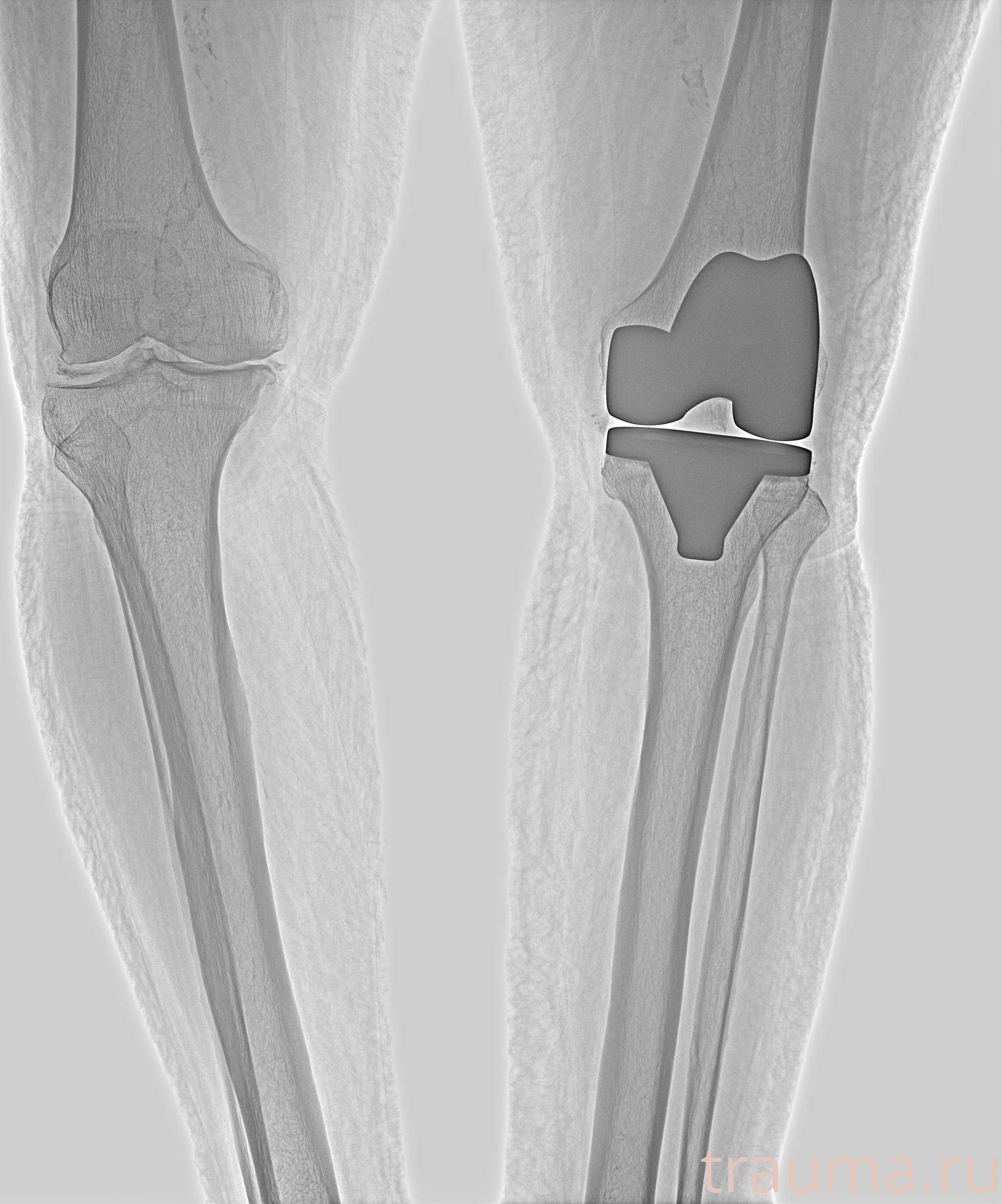 Рентген на дому: по вашему адресу приезжает врач-рентгенолог, травматолог-ортопед с мобильным рентгеновским аппаратом, проводит диагностику травмы или заболевания, делает необходимые рентгенограммы, дает рекомендации по дальнейшему лечению. Получить качественные снимки в домашних условиях возможно благодаря уникальной методике, разработанной МосРентген Центром для института  Склифосовского