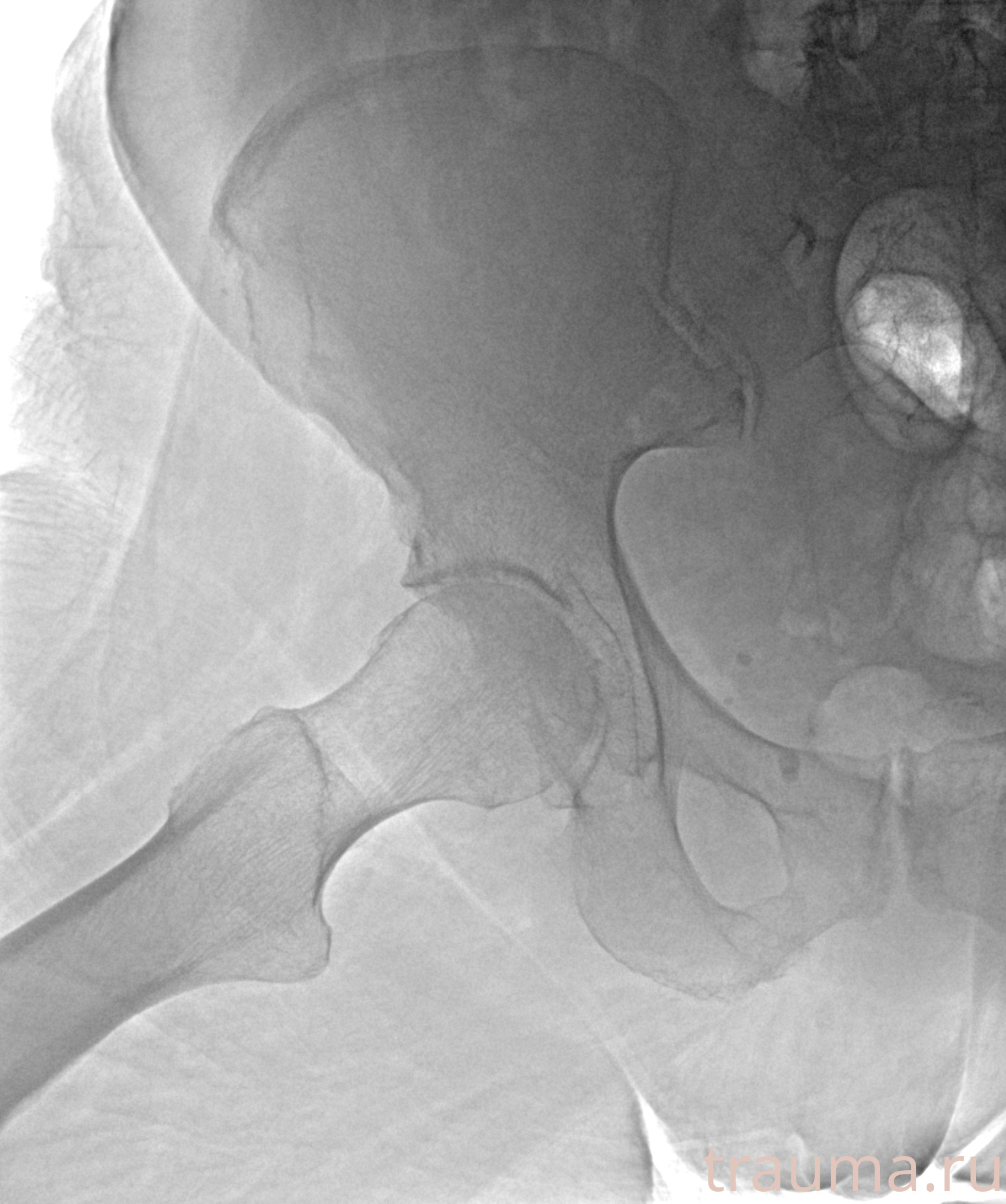 Рентген на дому: по вашему адресу приезжает врач-рентгенолог, травматолог-ортопед с мобильным рентгеновским аппаратом, проводит диагностику травмы или заболевания, делает необходимые рентгенограммы, дает рекомендации по дальнейшему лечению. Получить качественные снимки в домашних условиях возможно благодаря уникальной методике, разработанной МосРентген Центром для института  Склифосовского