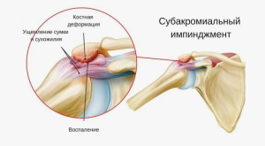 Фиксация сухожилий вращательной манжеты при полном лизисе большого бугорка плечевой кости Фиксация сухожилий вращательной манжеты при полном лизисе большого бугорка плечевой кости