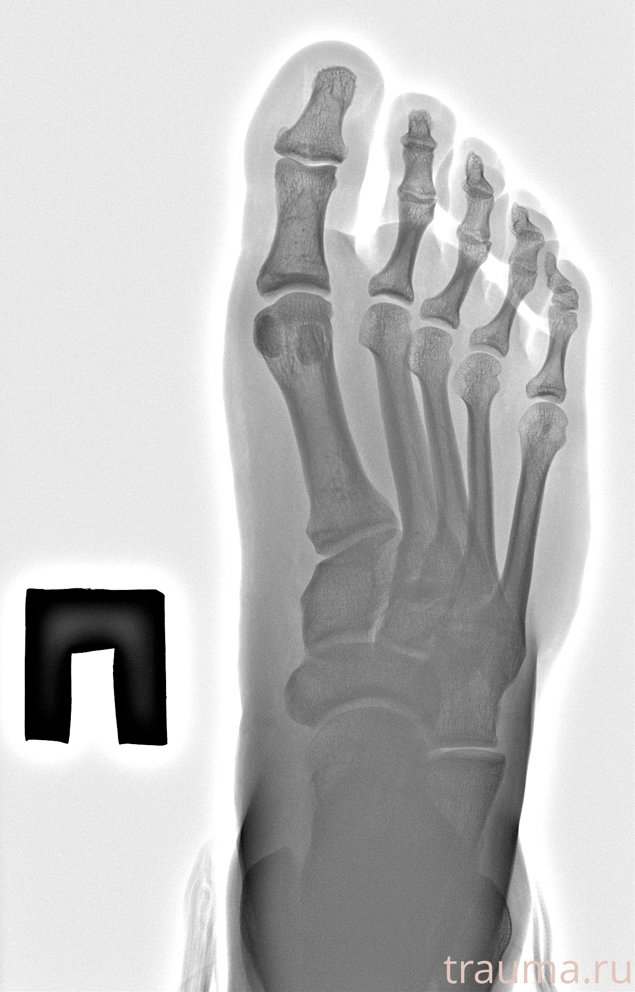 Рентген на дому: по вашему адресу приезжает врач-рентгенолог, травматолог-ортопед с мобильным рентгеновским аппаратом, проводит диагностику травмы или заболевания, делает необходимые рентгенограммы, дает рекомендации по дальнейшему лечению. Получить качественные снимки в домашних условиях возможно благодаря уникальной методике, разработанной МосРентген Центром для института  Склифосовского