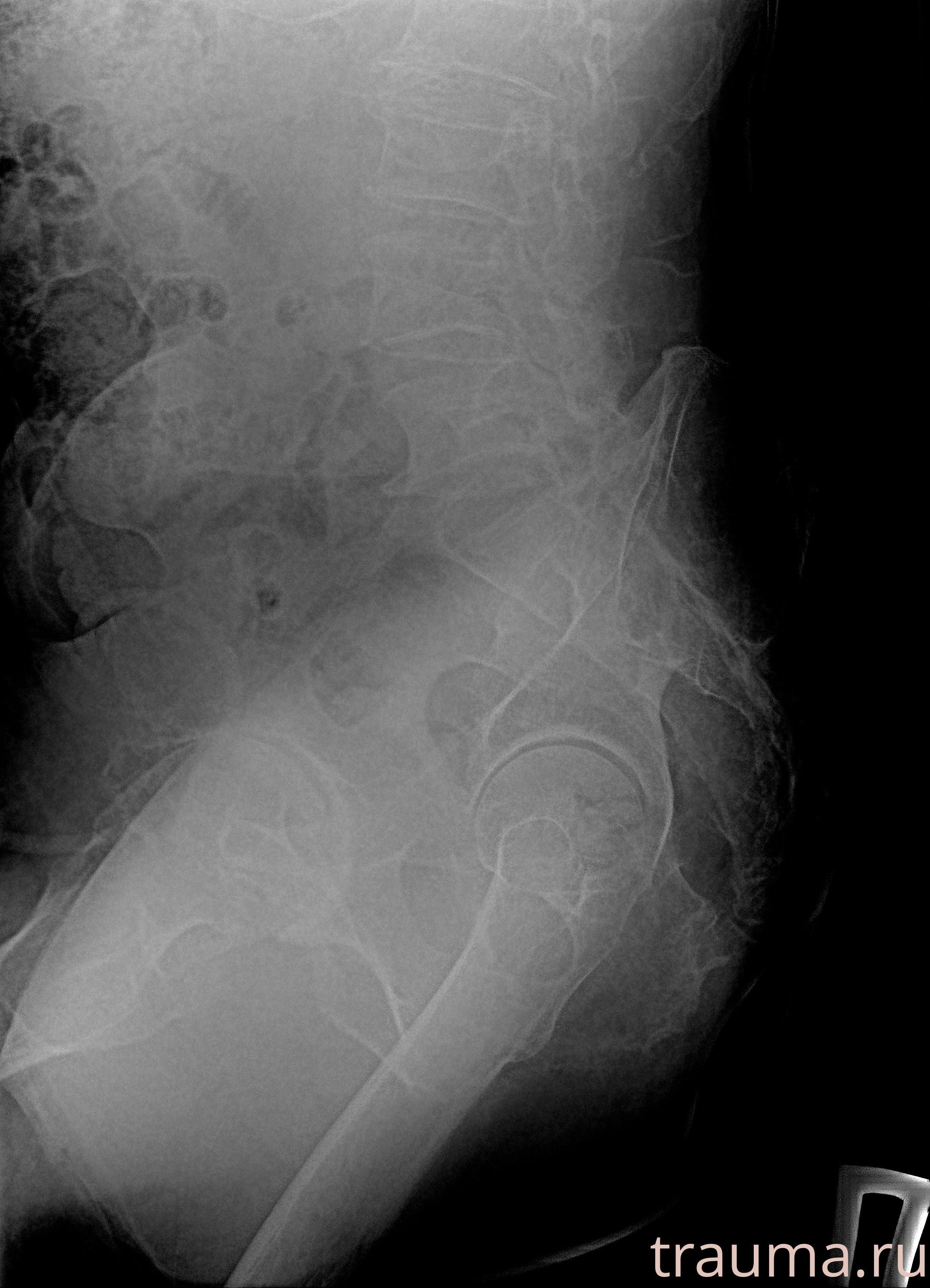 Рентген на дому: по вашему адресу приезжает врач-рентгенолог, травматолог-ортопед с мобильным рентгеновским аппаратом, проводит диагностику травмы или заболевания, делает необходимые рентгенограммы, дает рекомендации по дальнейшему лечению. Получить качественные снимки в домашних условиях возможно благодаря уникальной методике, разработанной МосРентген Центром для института  Склифосовского